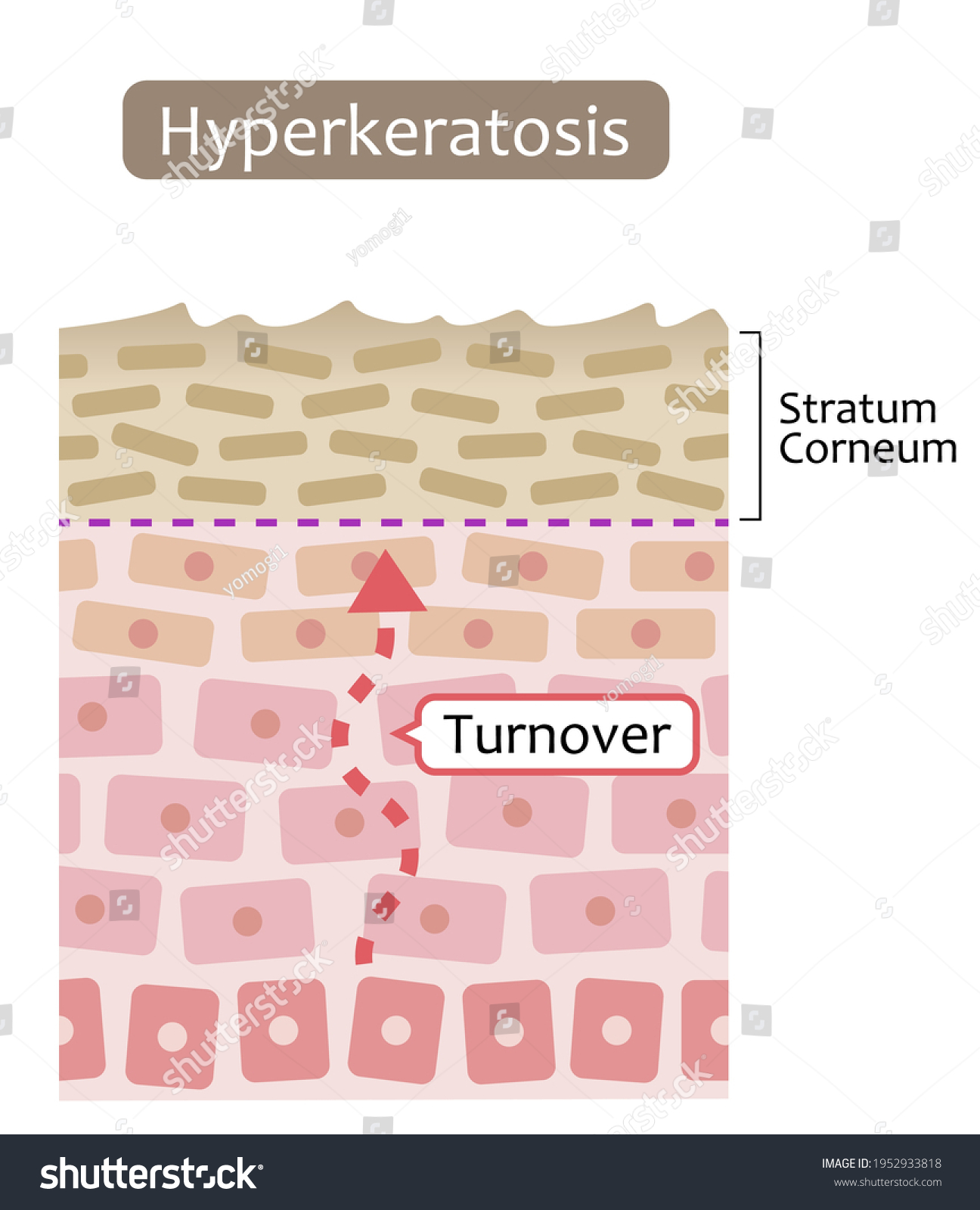 Diagram Of Skin Cell Turnover And Thickening Of Royalty Free Stock Vector 1952933818