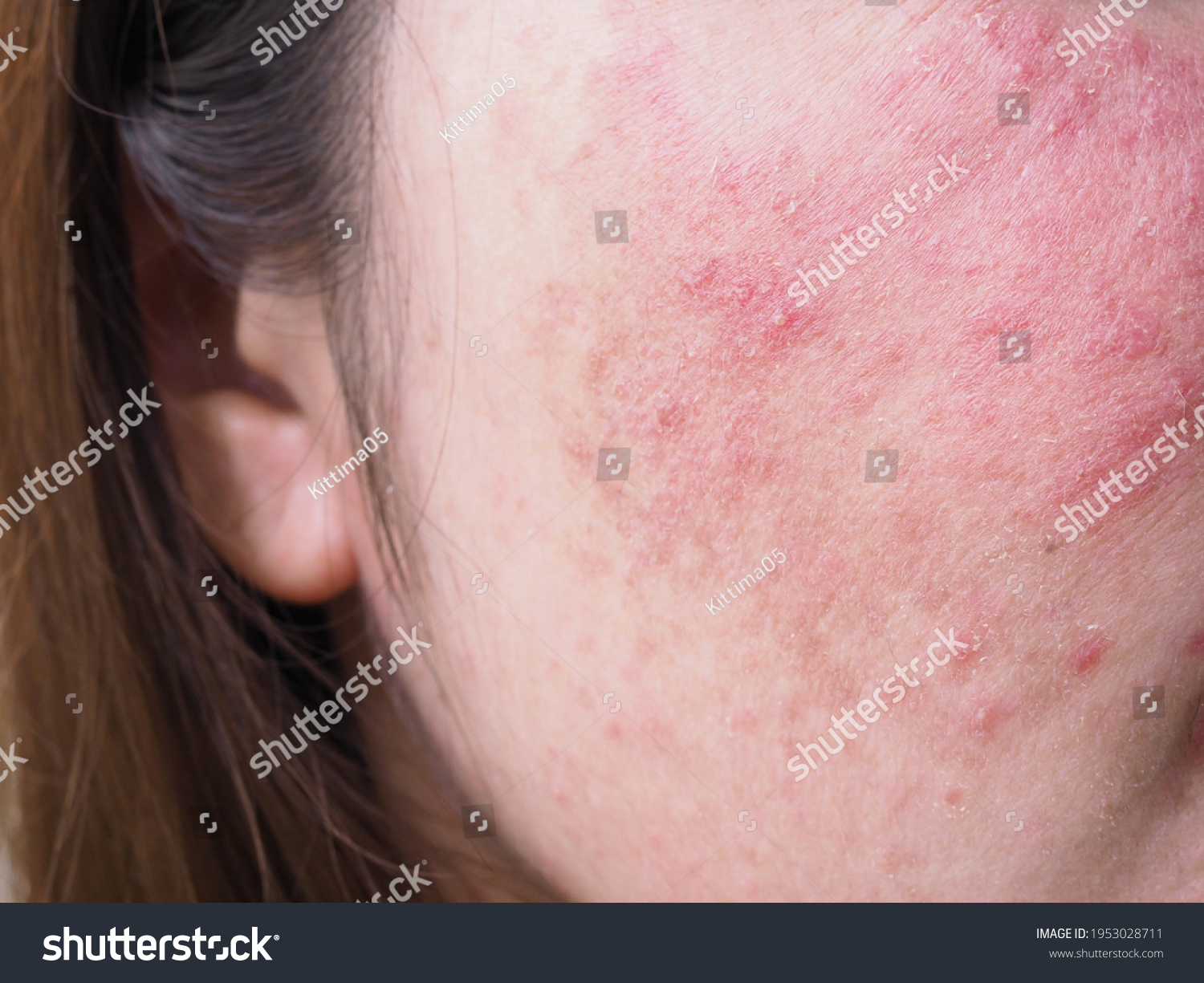 Red rash on young Asian Thai woman face, Itchy and allergic skin problems, dermatitis. #1953028711