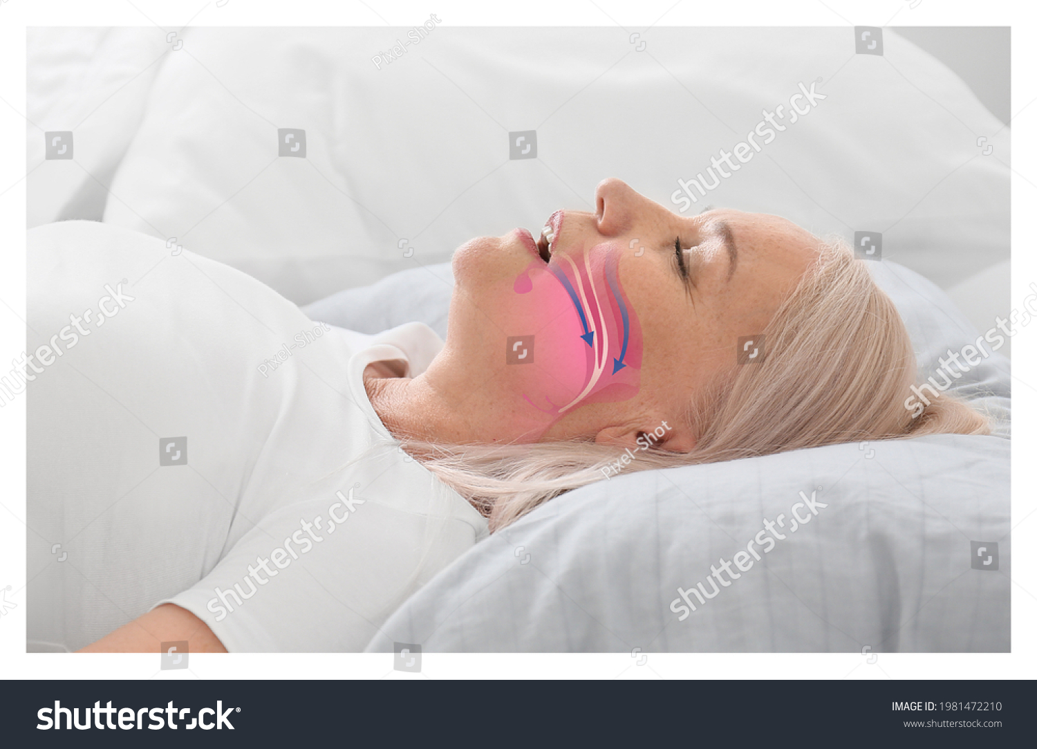 Illustration showing airway during obstructive sleep apnea #1981472210