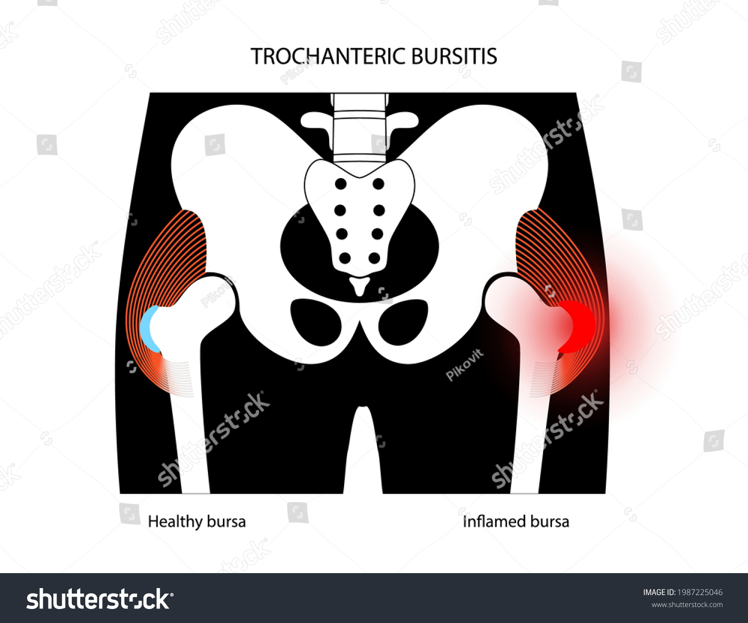 Trochanteric bursitis inflammation. Inflamed - Royalty Free Stock ...