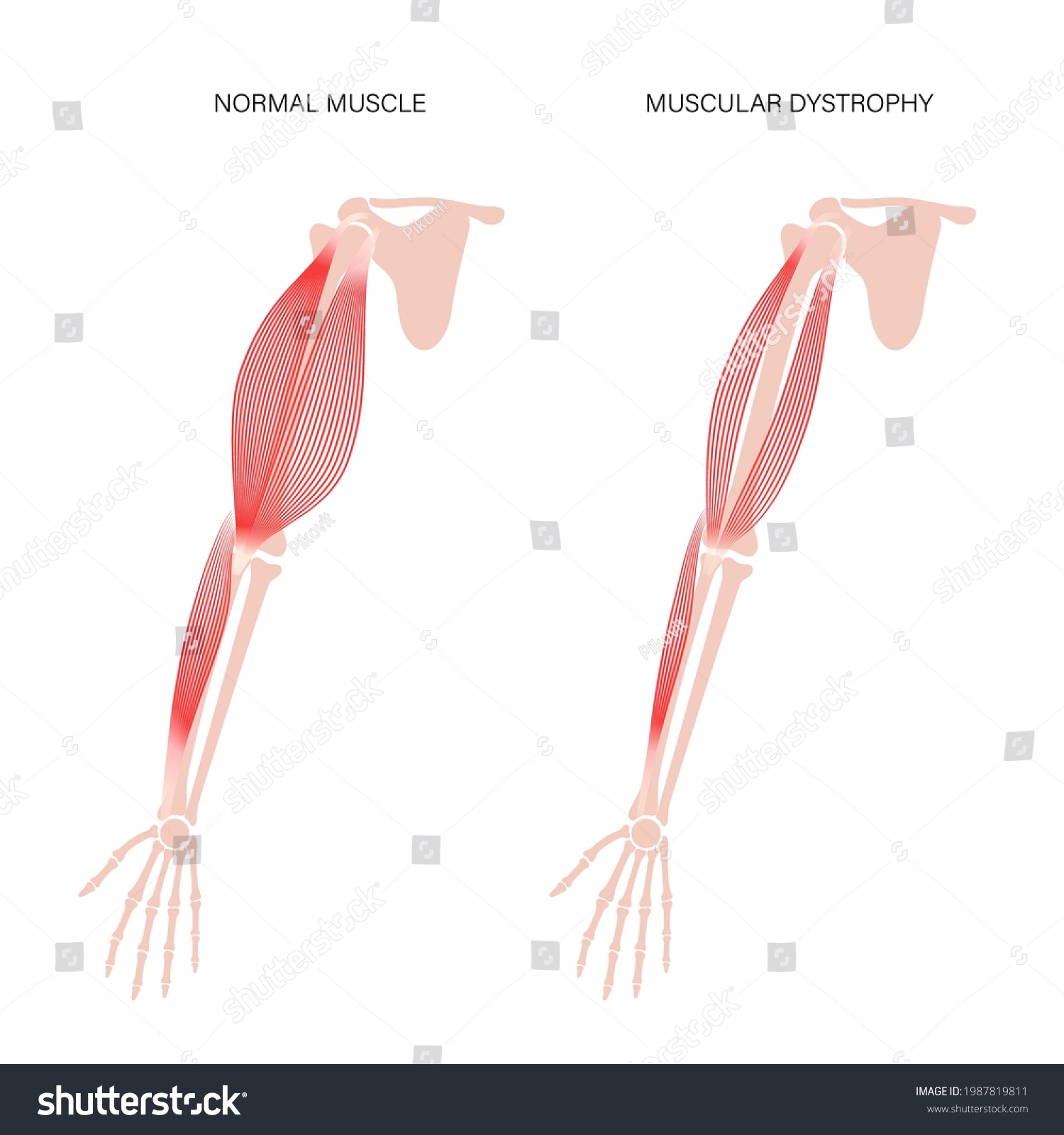 Muscular dystrophy concept. Disease in human arm - Royalty Free Stock ...