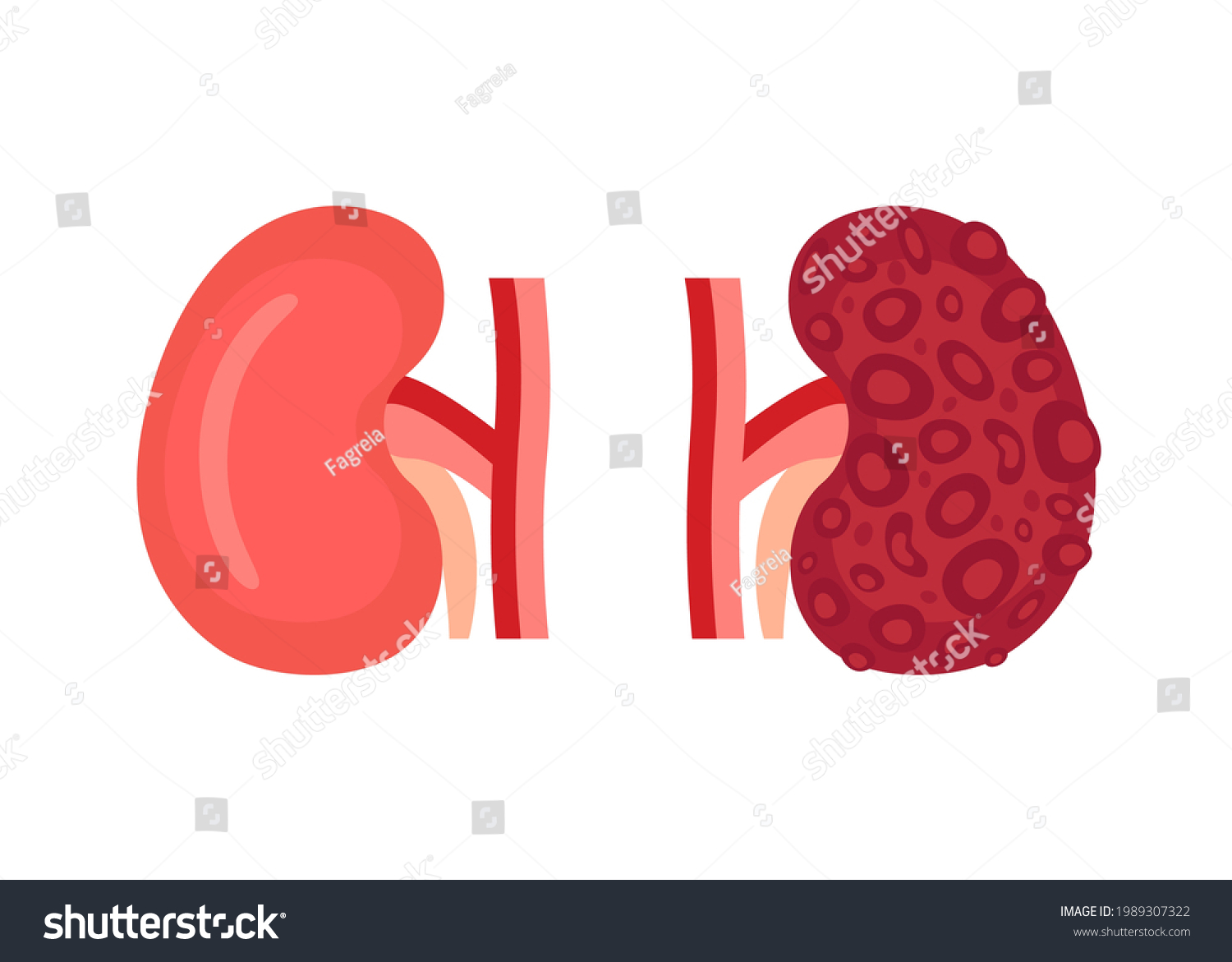 Healthy kidney and unhealthy disease kidney with - Royalty Free Stock ...