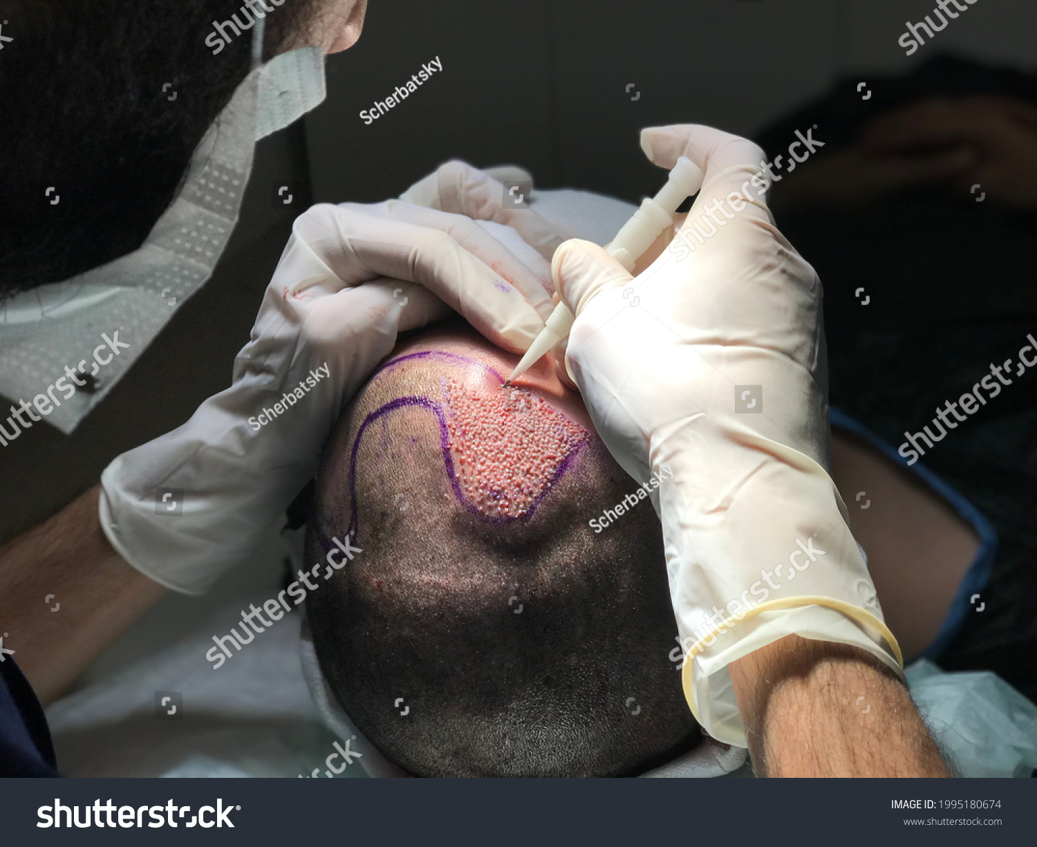 Hair Transplant in Medical Clinic #1995180674