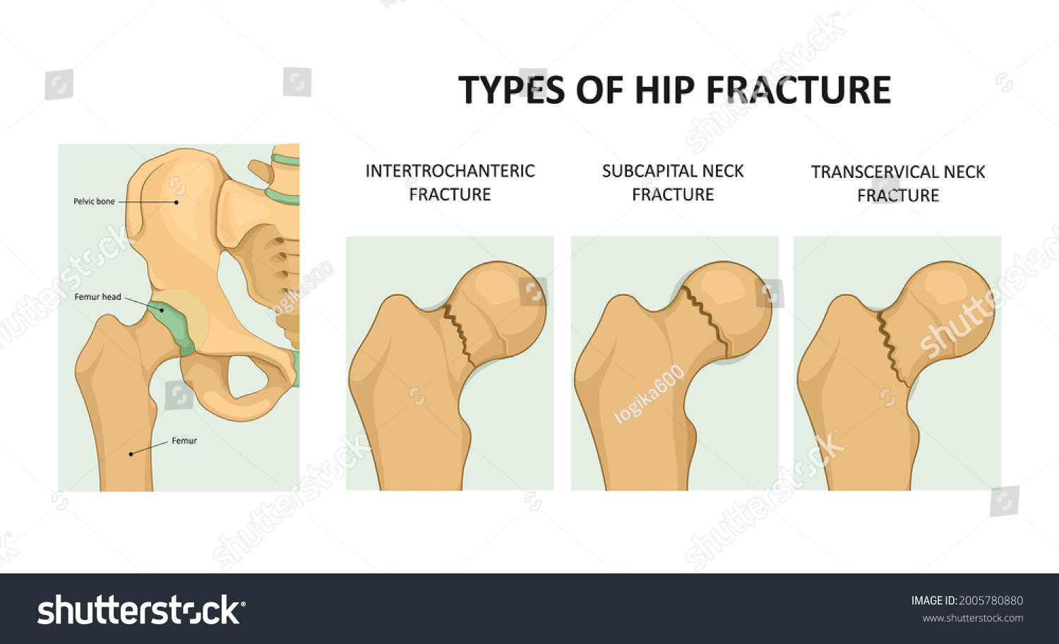 Types Of Hip Fracture Femoral Neck Fracture Royalty Free Stock Vector 2005780880 8899