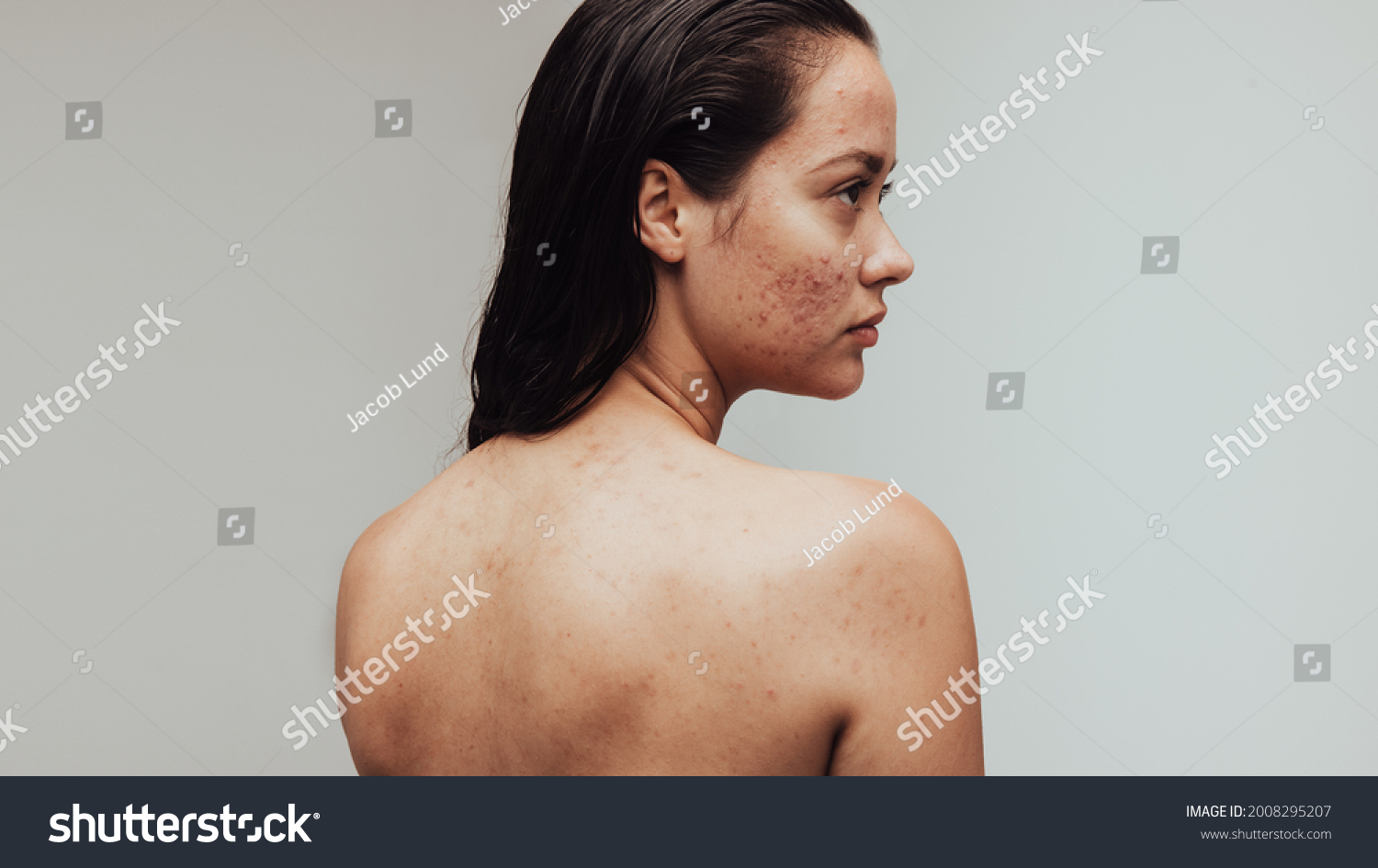 Portrait of woman having acne inflammation on face and body. Rear view close up of woman with pimples on face. #2008295207