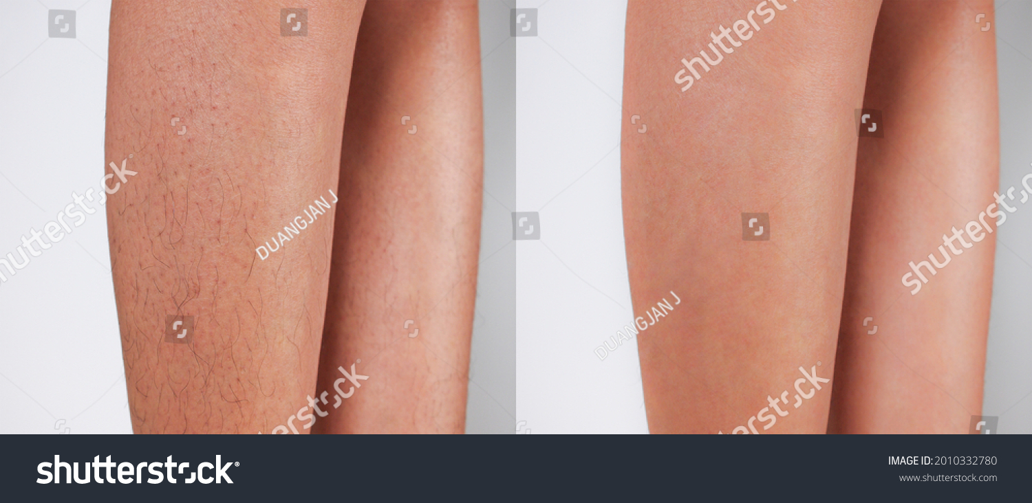 Image before and after Legs hairs removal concept.  #2010332780