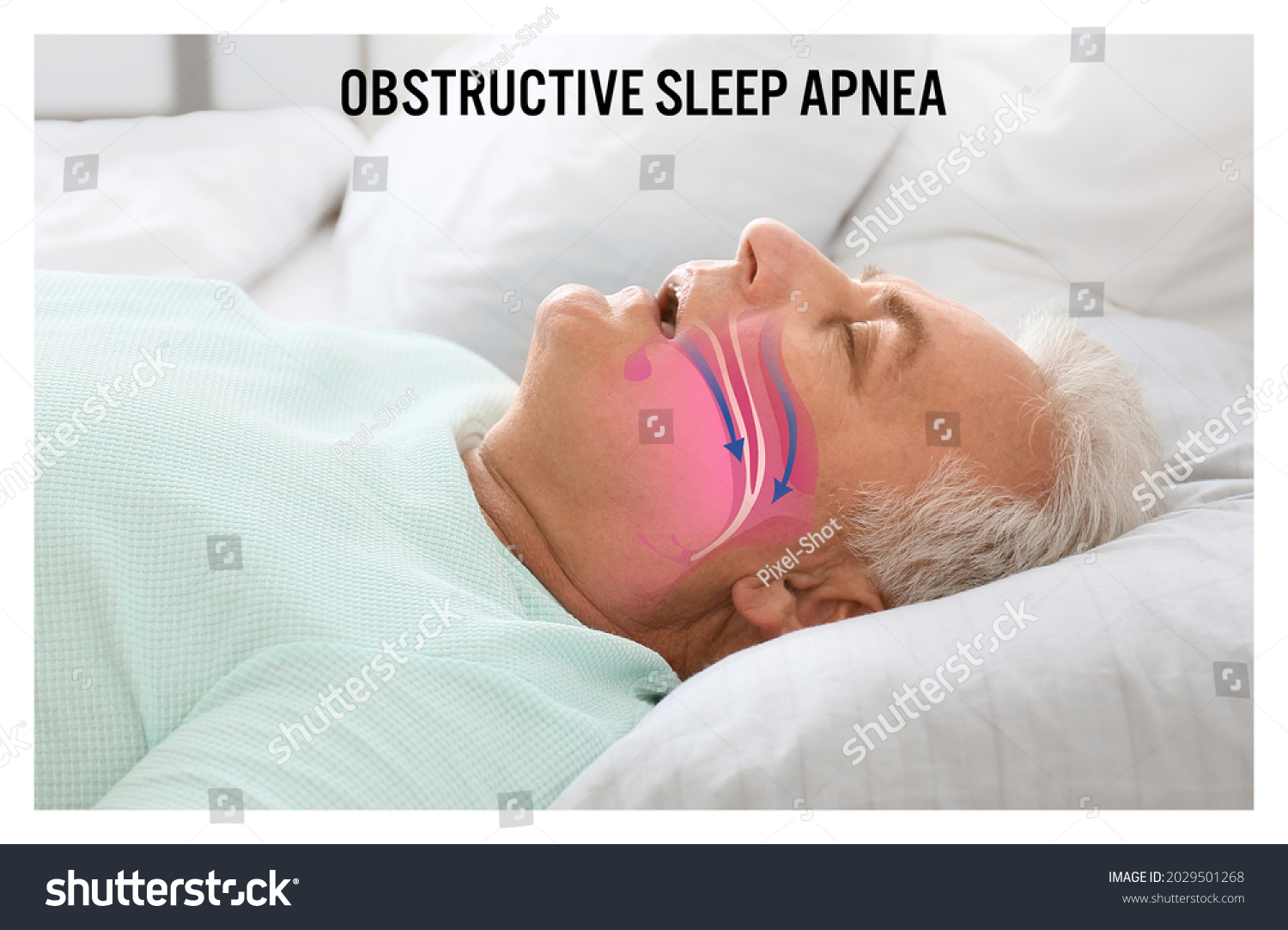 Illustration showing airway during obstructive sleep apnea #2029501268