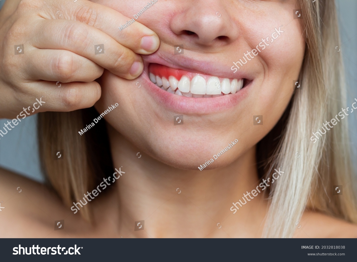 Gum inflammation. Close-up of a young woman showing bleeding gums on a gray background. Dentistry, dental care #2032818038