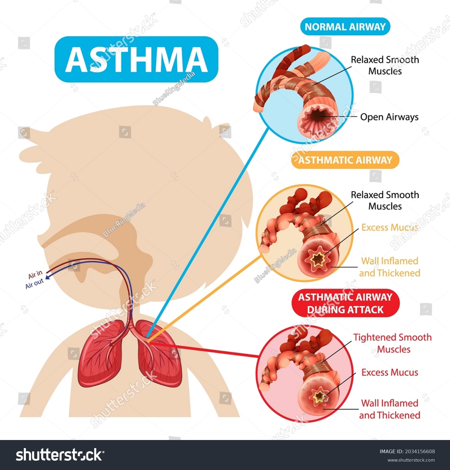 Asthma Diagram With Normal Airway And Asthmatic Royalty Free Stock