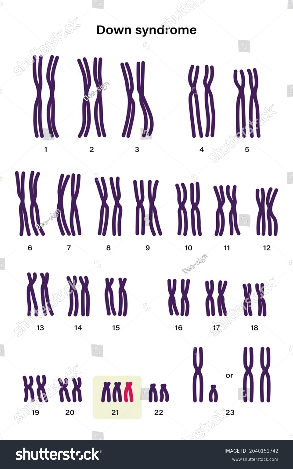 Human Karyotype Of Down Syndrome Autosomal Royalty Free Stock Vector 2040151742 1292