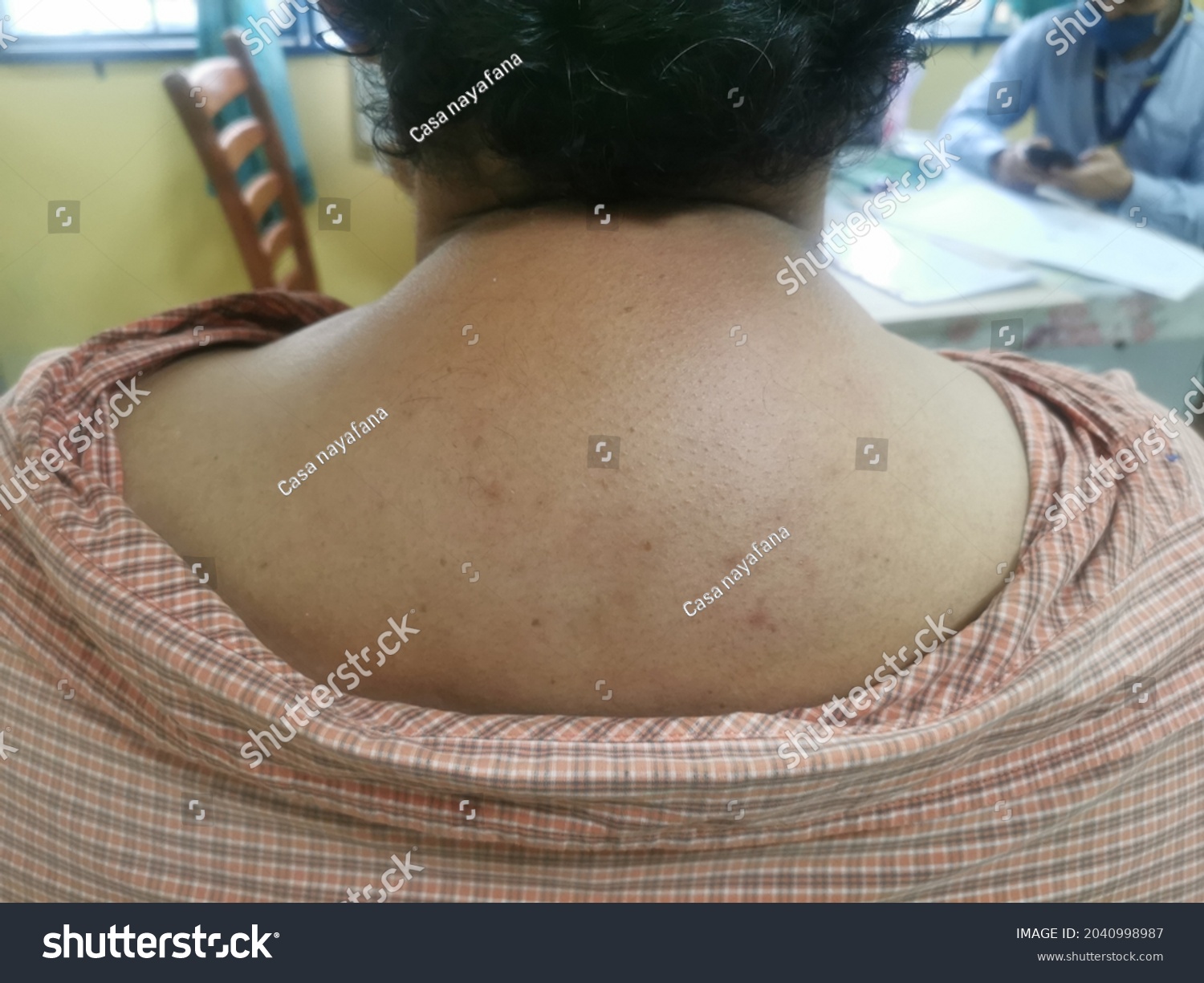 Buffalo hump, swelling at the nape in patient with Cuahing Disease. #2040998987
