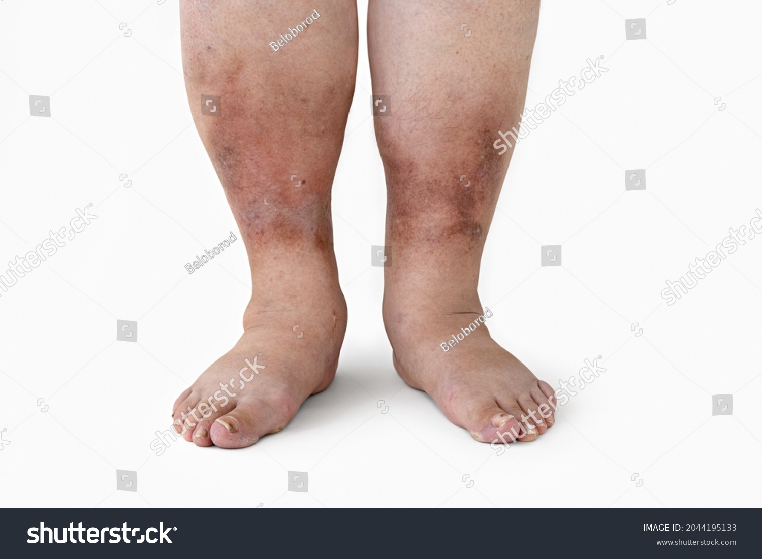 Swelling of the leg with inflammation in diabetic nephropathy in a woman, close-up. #2044195133