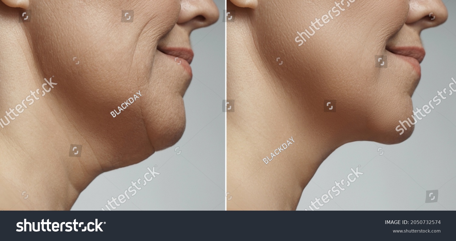 Difference after plastic surgery. Double chin removal, facelift and neck liposuction. #2050732574