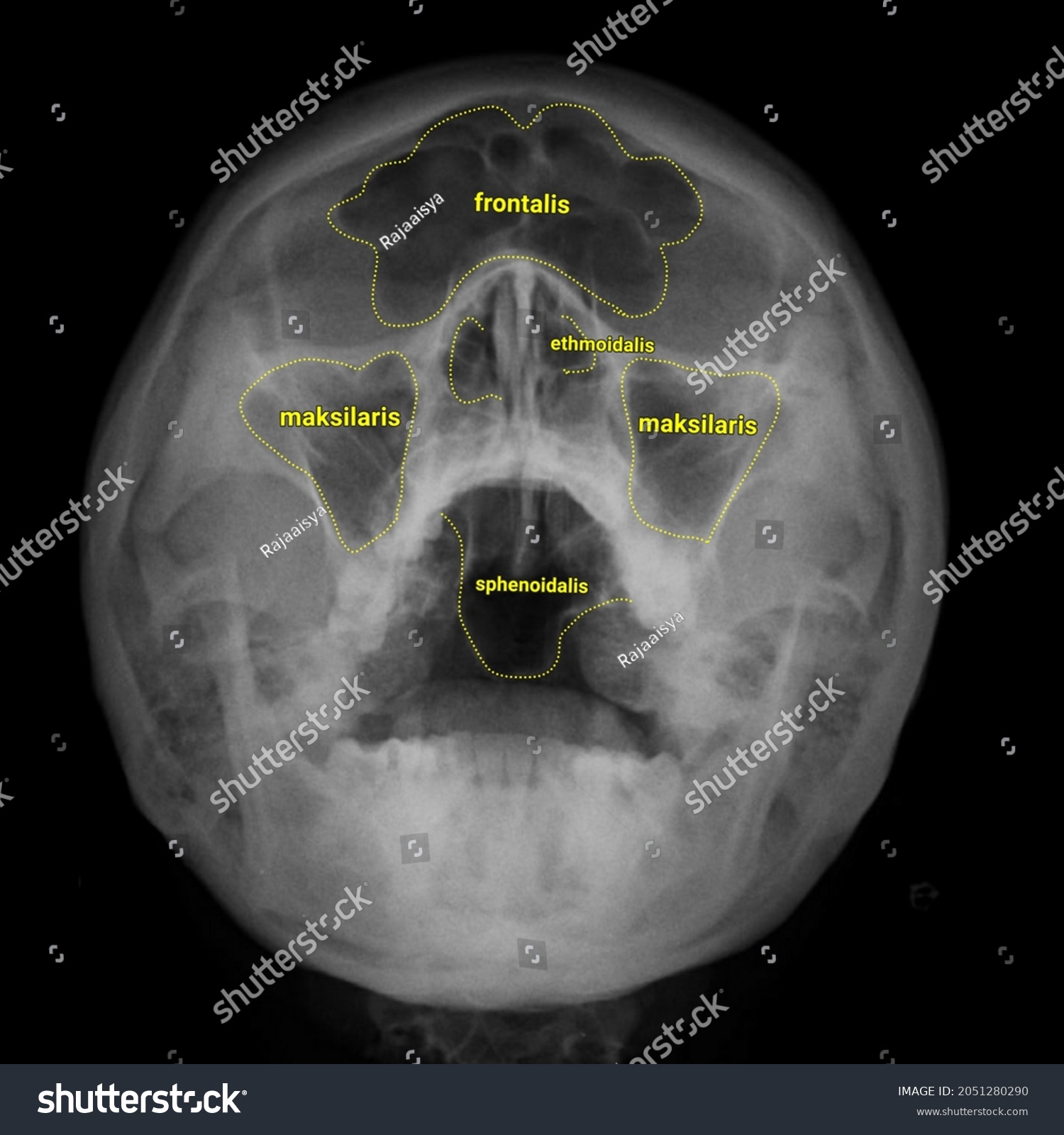 Waters xray paranasal sinus anatomy Royalty Free Stock Vector