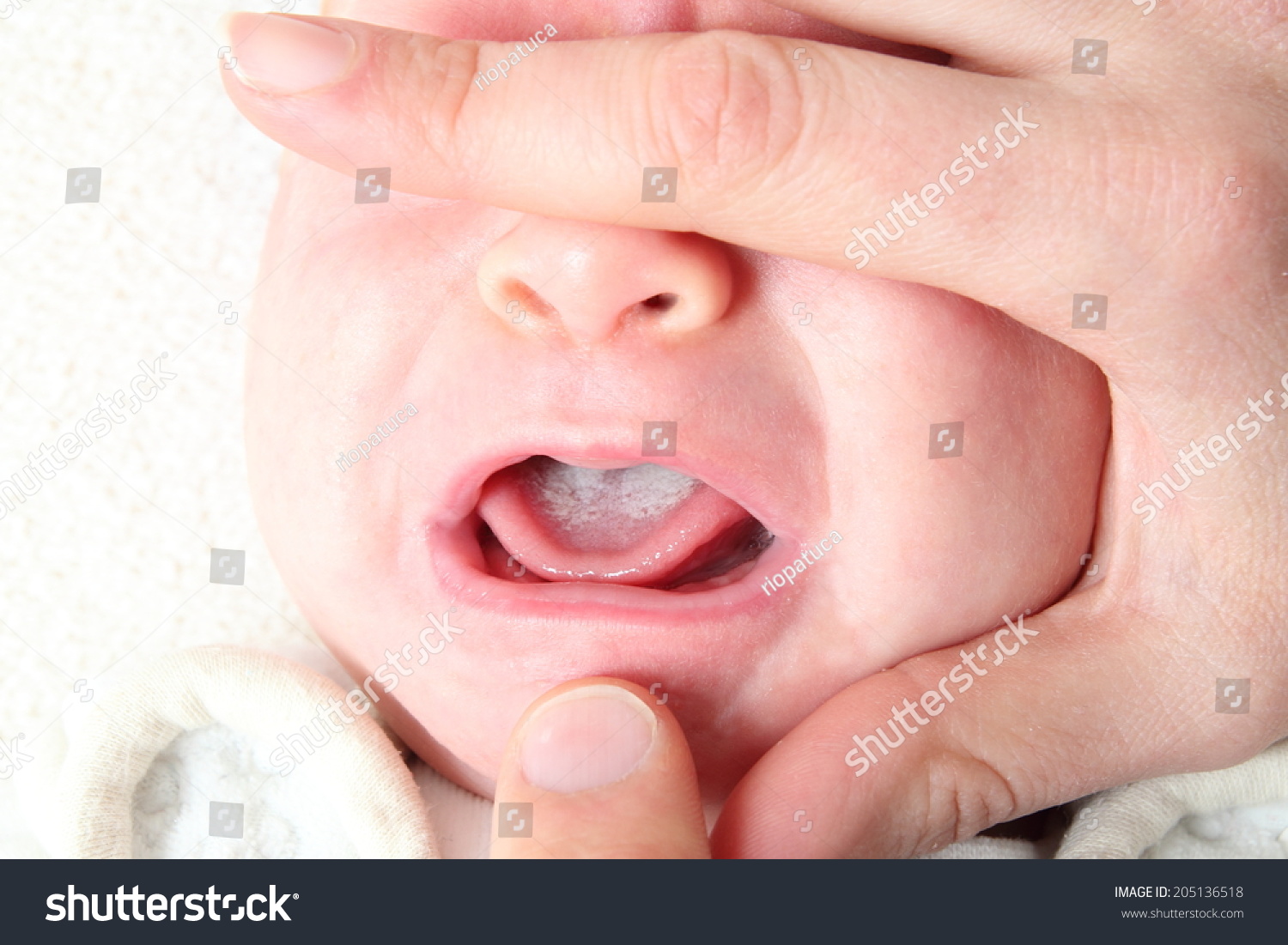 Oral thrush of a newborn baby #205136518