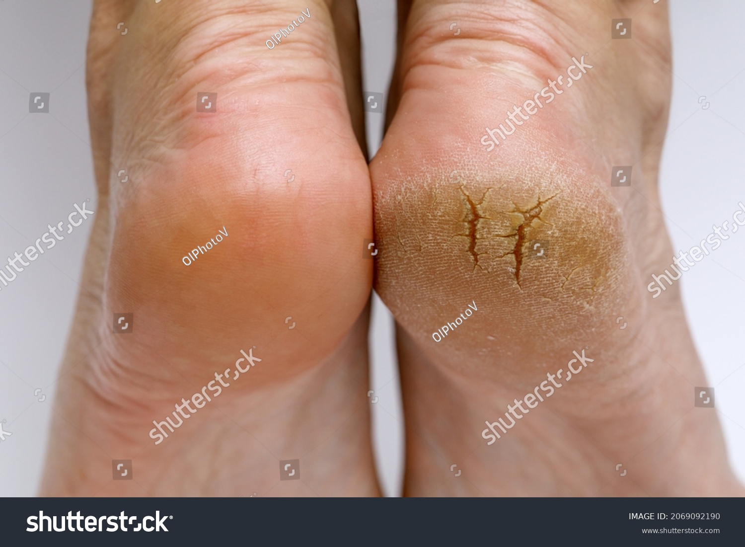 Cracked heels before and after treatment and treatment. Medical pedicure in a beauty salon. Problematic dehydrated feet with dry skin. Close-up photo of legs.  #2069092190