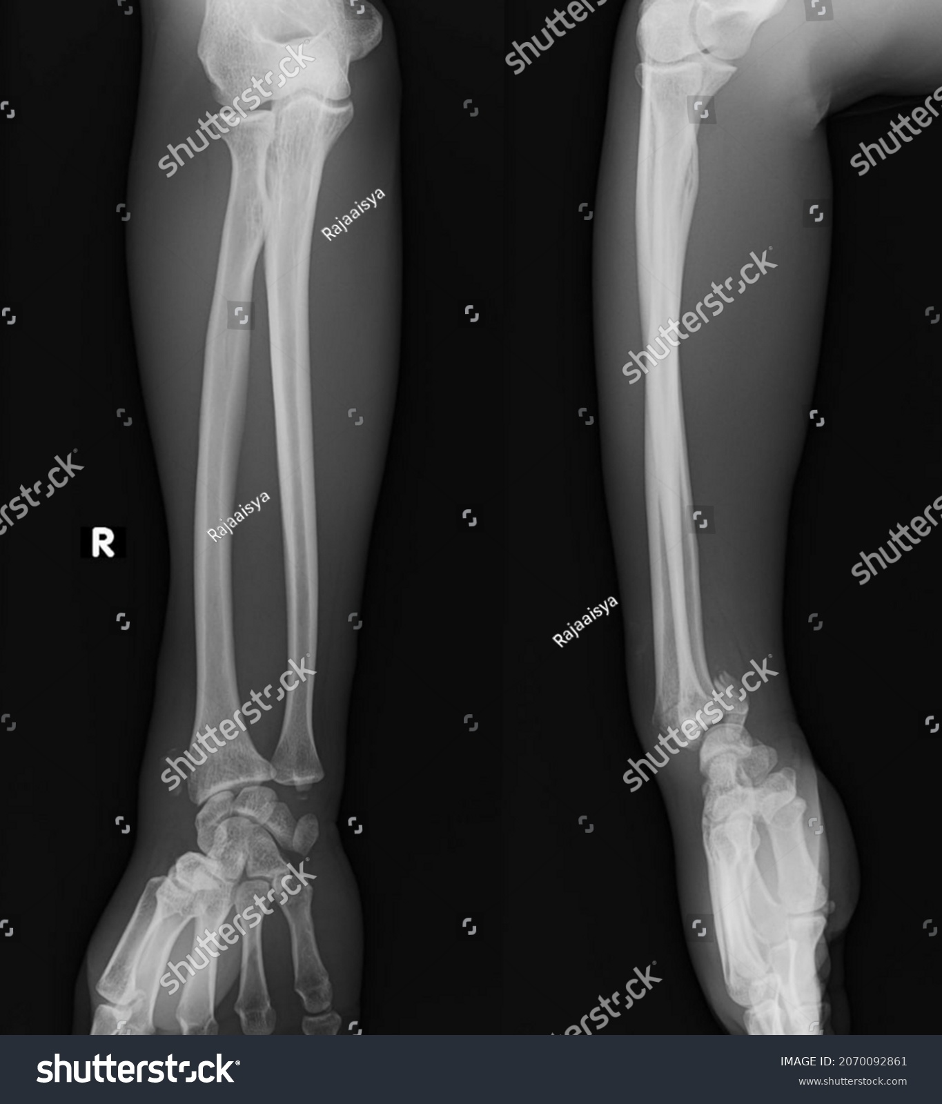 x ray image of distal radius fracture smith fracture #2070092861