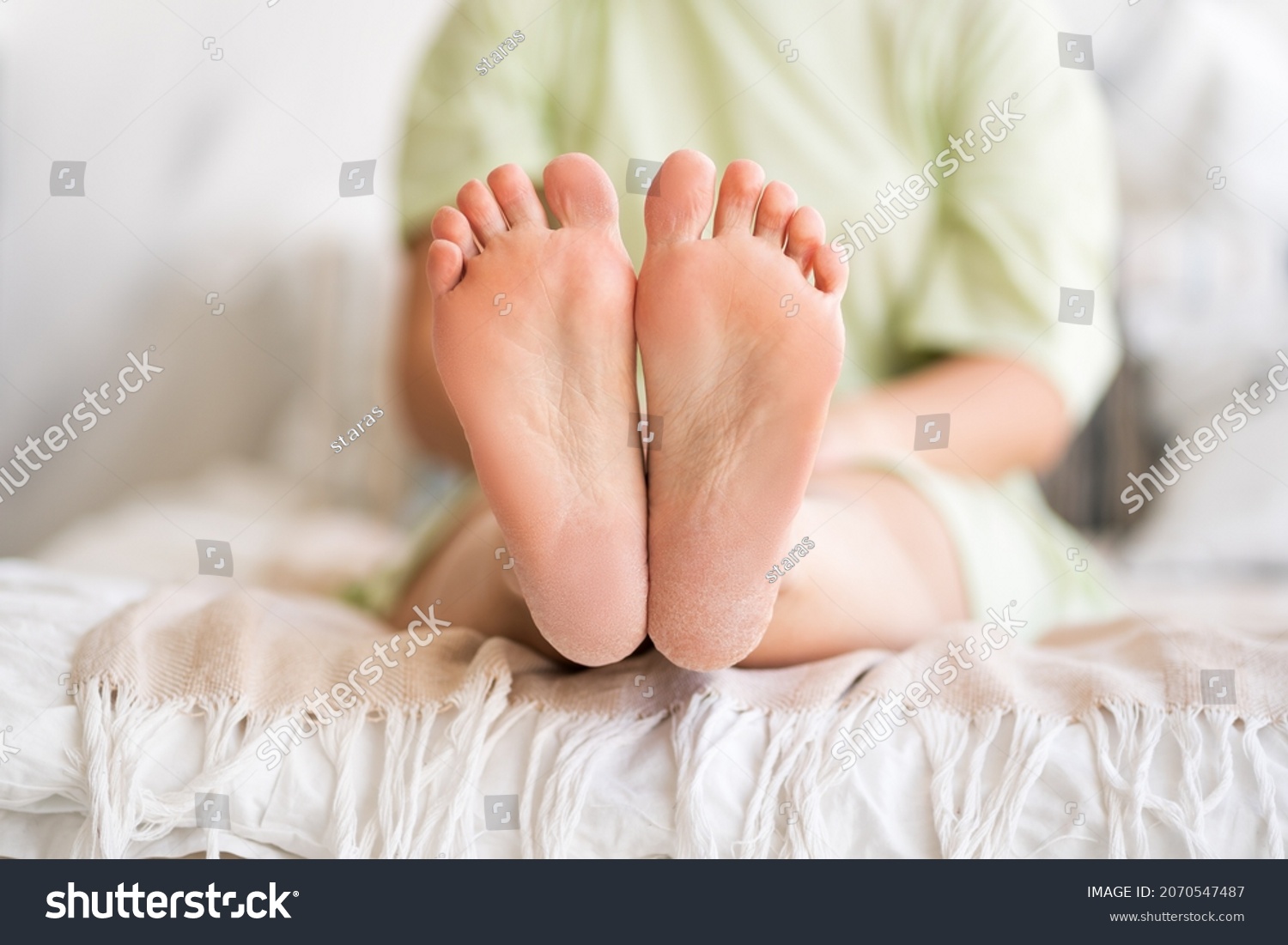 Woman relaxing in bedroom, female feet with dry cracked skin close-up, foot care concept, home interior #2070547487