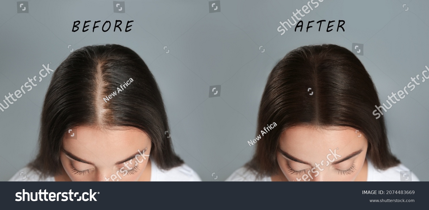 Woman with hair loss problem before and after treatment on grey background, collage. Visiting trichologist #2074483669