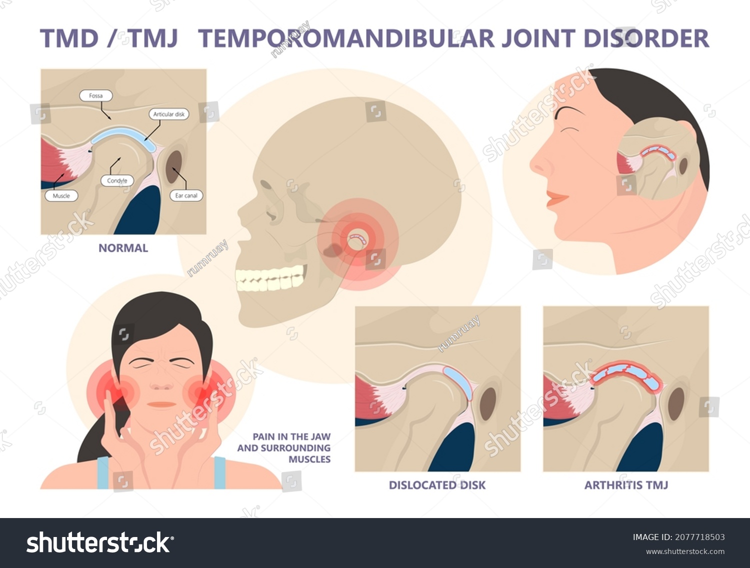 Temporomandibular Joint Disorders TMD TMJ treat - Royalty Free Stock ...