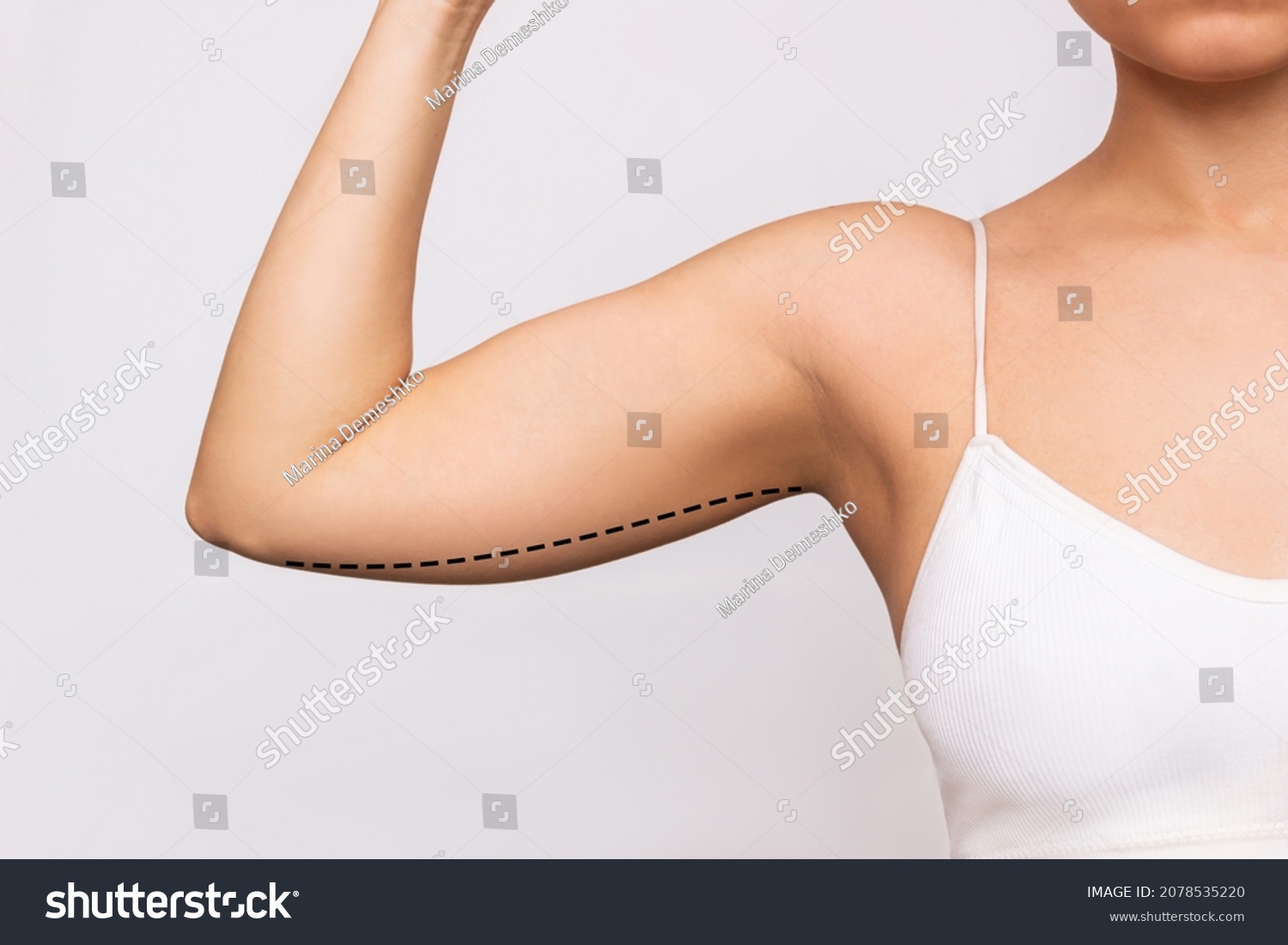 Cropped shot of a young woman with excess fat on her upper arm with marks for liposuction or plastic surgery isolated on a gray background. The loose and saggy muscles. Overweight. Beauty concept #2078535220