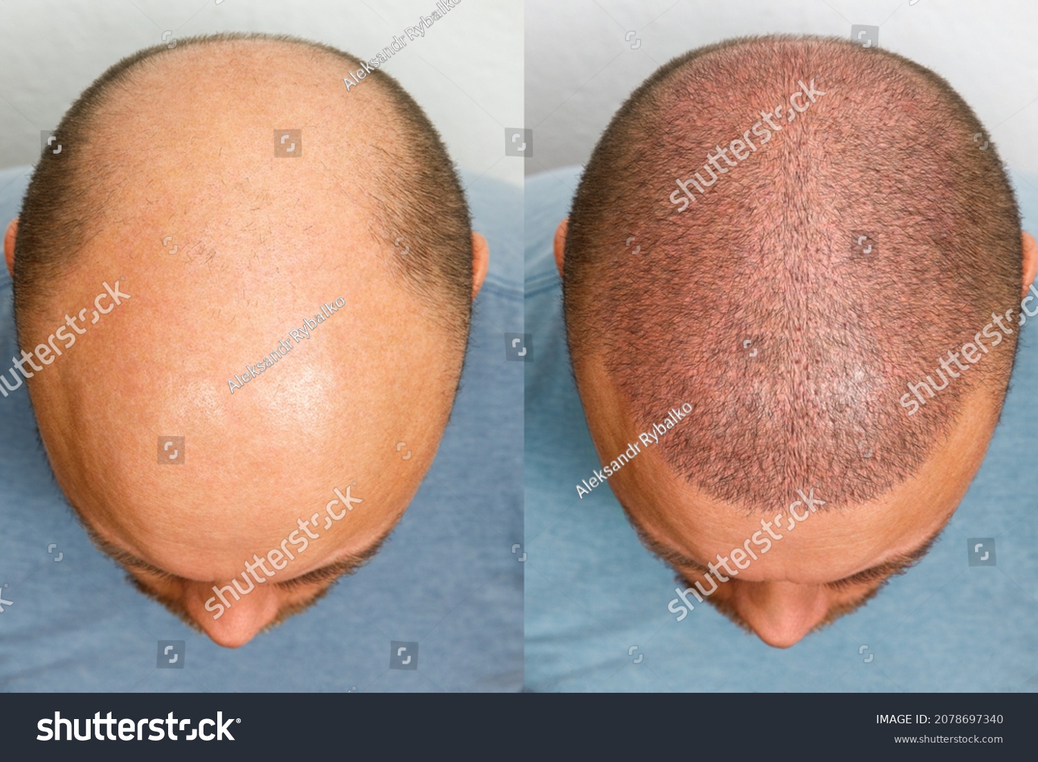The head of a balding man before and after hair transplant surgery. A man losing his hair has become shaggy. An advertising poster for a hair transplant clinic. Treatment of baldness. #2078697340