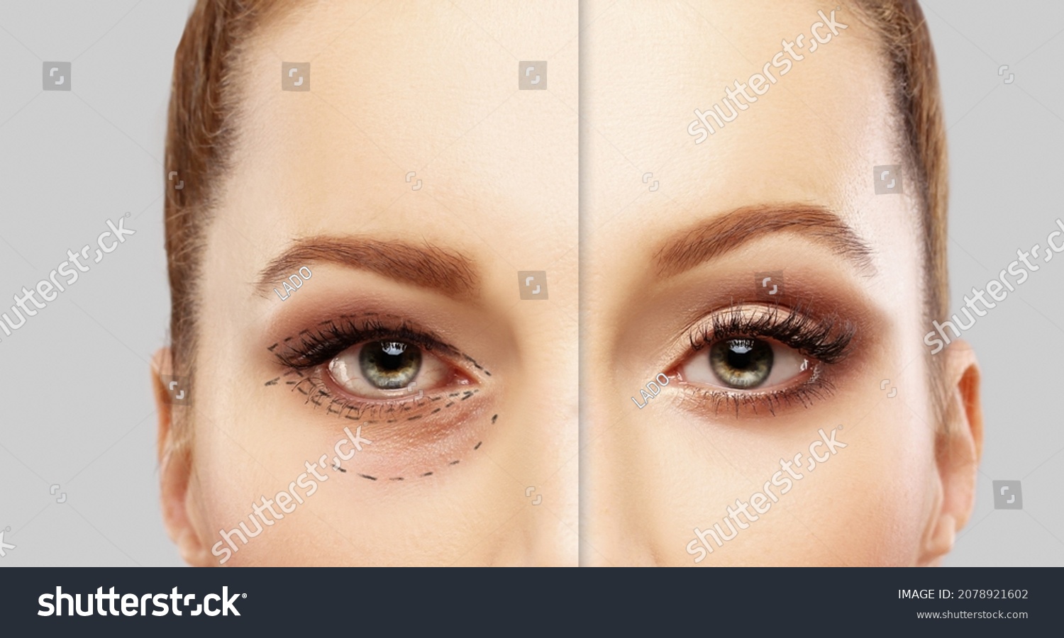 Lower and upper Blepharoplasty.Marking the face.Perforation lines on females face, plastic surgery concept. #2078921602
