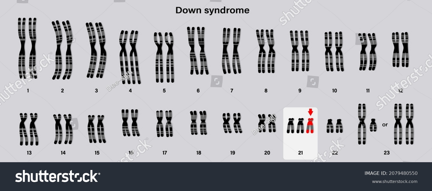 Human Karyotype Of Down Syndrome Autosomal Royalty Free Stock Vector 2079480550 3211