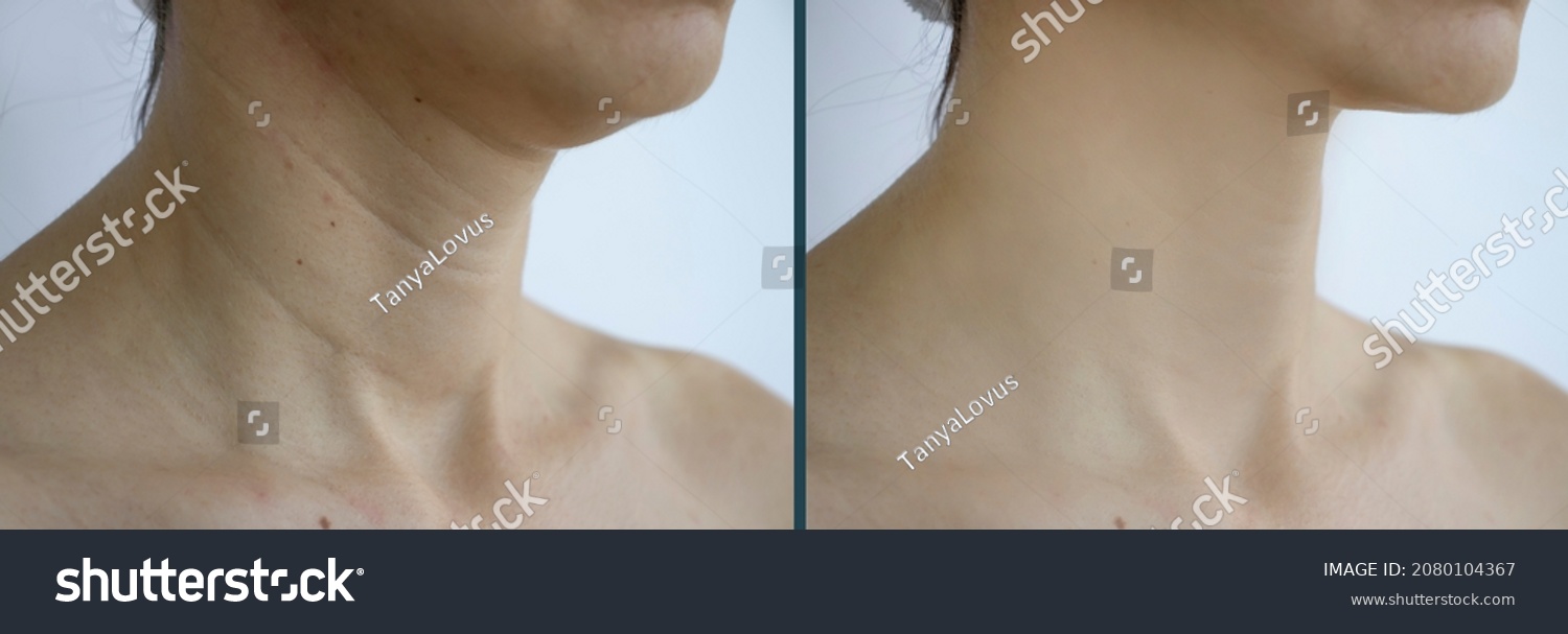 woman neck wrinkles before and after #2080104367