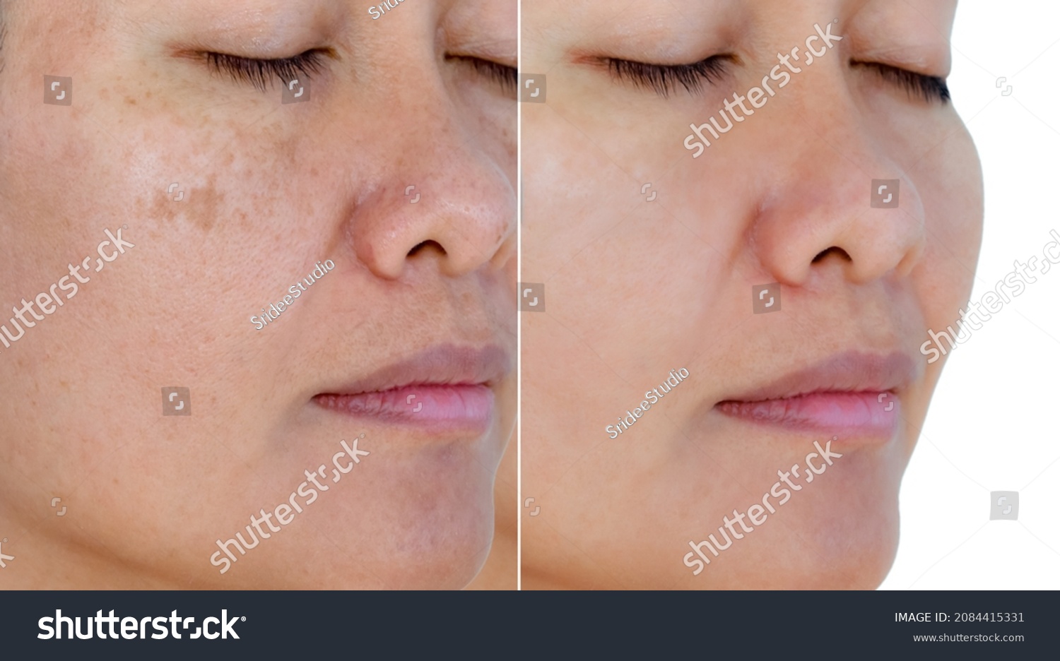 Image before and after spot melasma pigmentation facial treatment on middle age asian woman face. skincare and health problem concept.  #2084415331