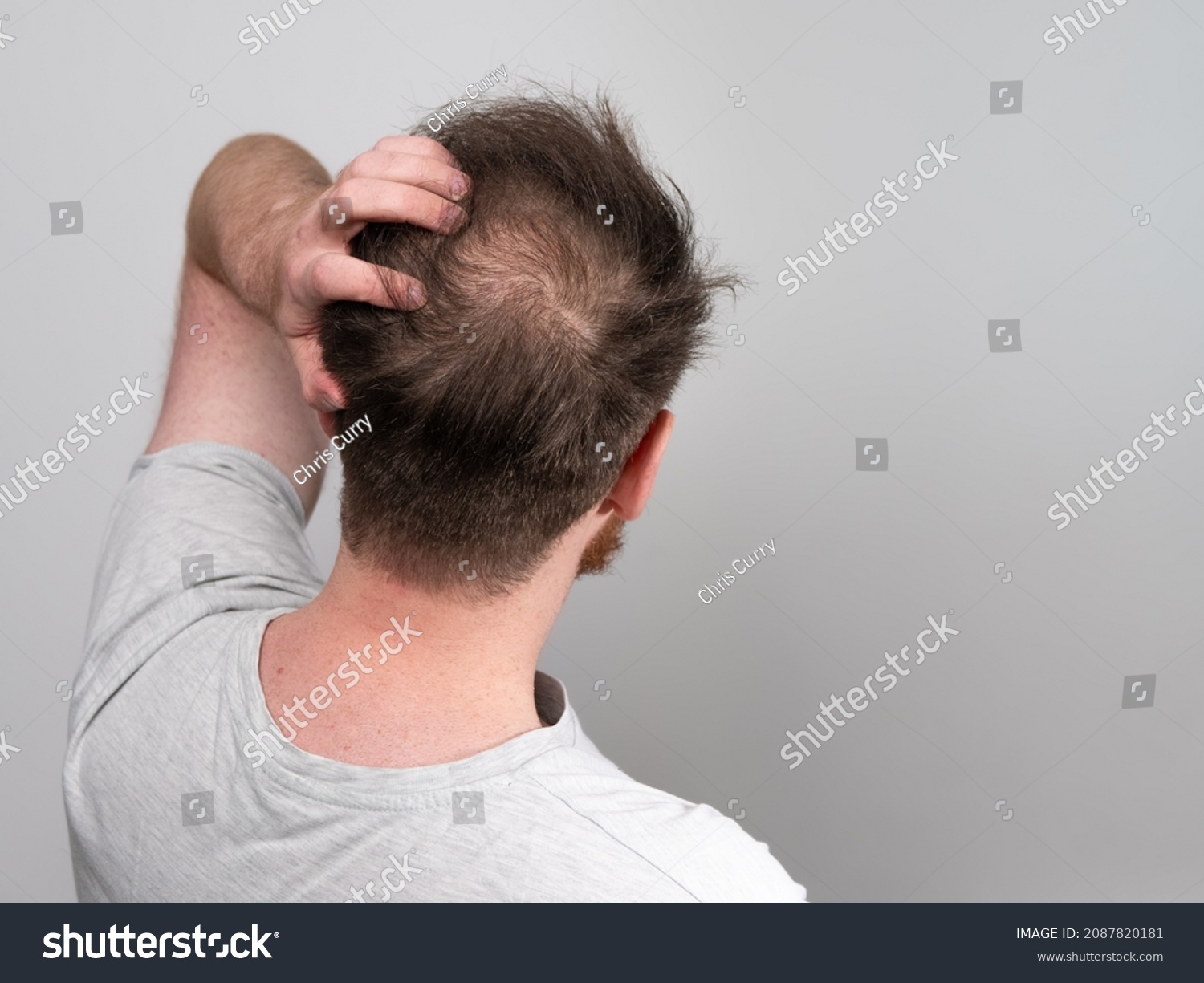 Behind view of a young balding man's head showing clear signs of balding and hair loss around the scalp. Male pattern baldness concept against a clear white background with room for text. #2087820181
