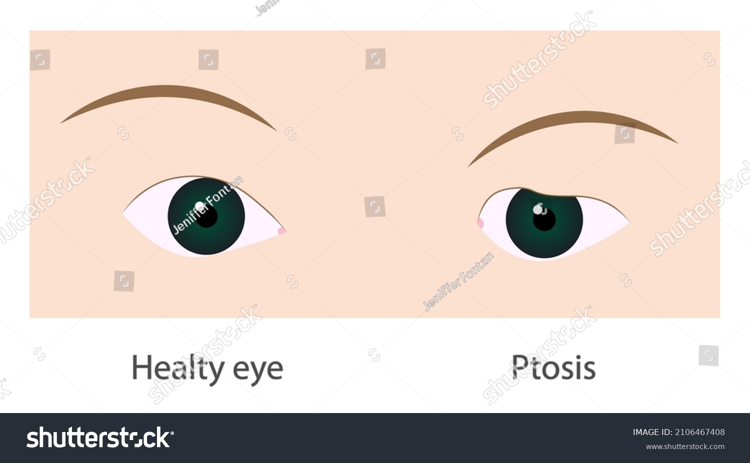 Ptosis. Normal Eye and a drooping of the upper - Royalty Free Stock ...