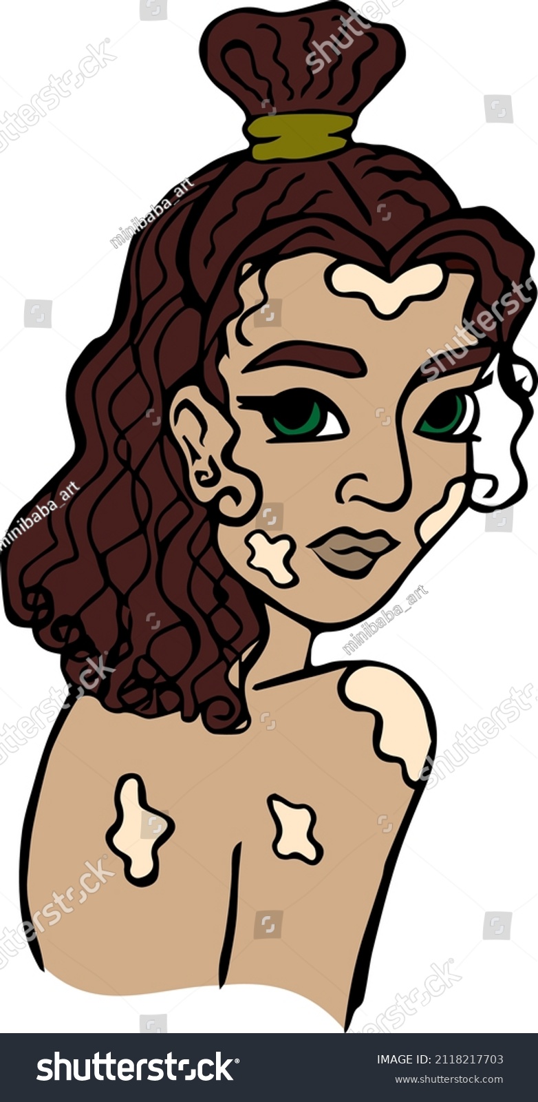 Beautiful Dark Skinned Girl With Vitiligo Royalty Free Stock Vector 2118217703 5785