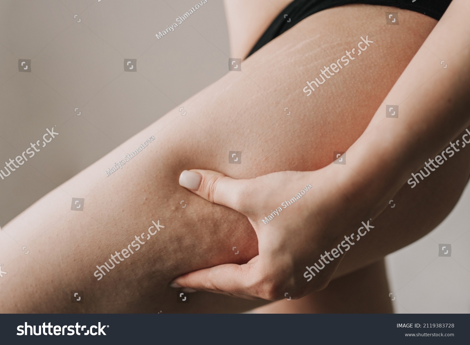 cellulite on the skin close up #2119383728