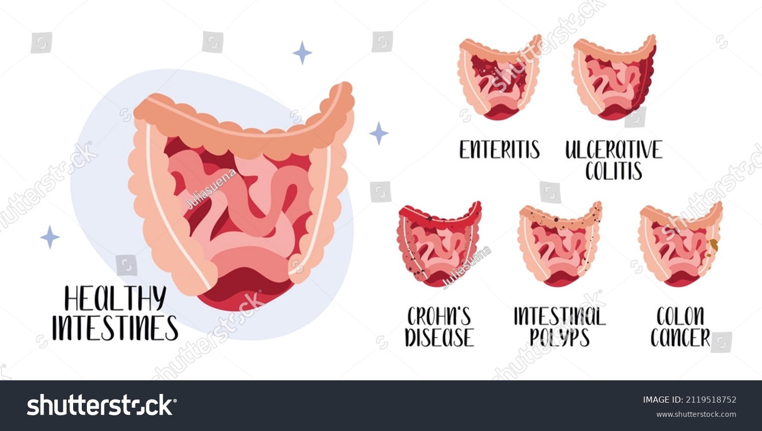 Healthy Intestines Gut Diseases Enteritis Royalty Free Stock 