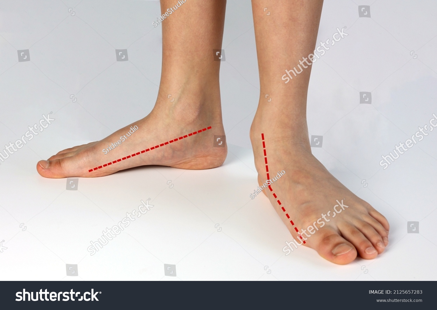 Compare normal healthy foot shape with flat foot fallen arch problem. The red line showing normal shape foot with abnormal shapes foot unstable medial column. #2125657283