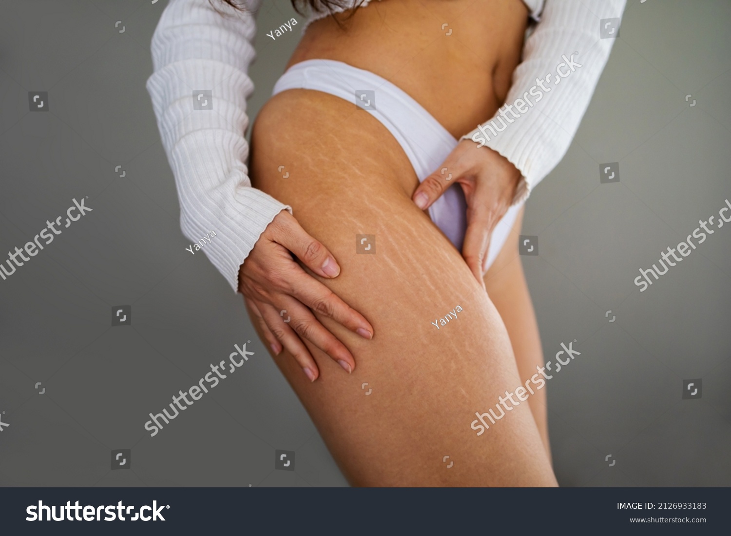 Stretch marks on female legs. A woman's hand holds a fat cellulite and a stretch mark on her leg. Cellulite. #2126933183