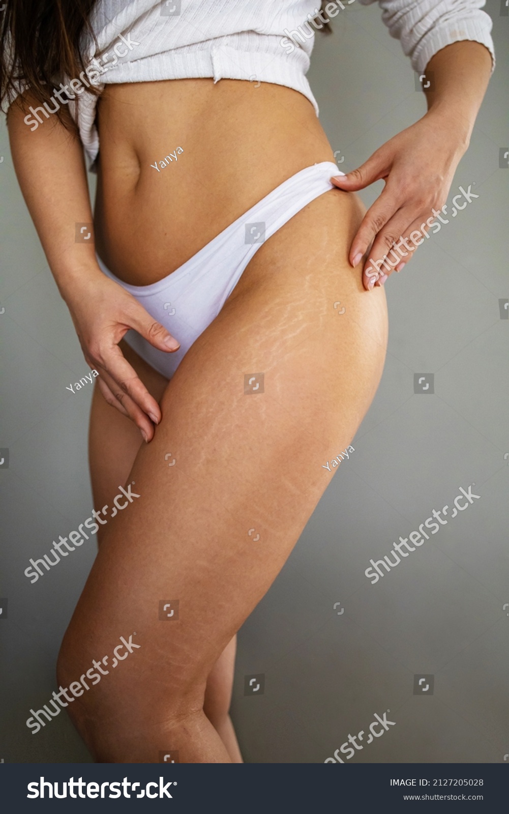 Stretch marks on female legs. A woman's hand holds a fat cellulite and a stretch mark on her leg. Cellulite. #2127205028