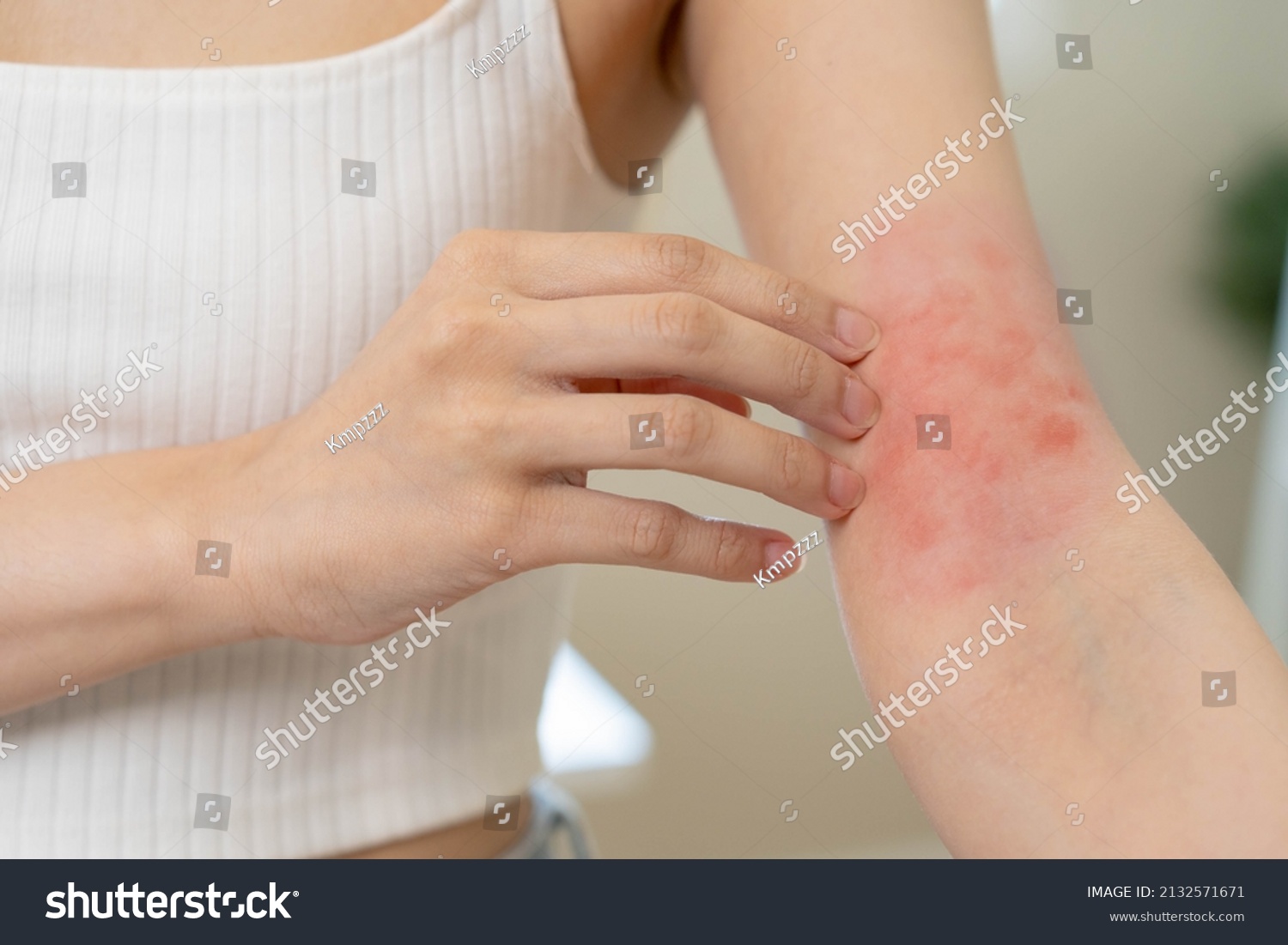 Dermatology, asian young woman, girl hand in her arm allergy, allergic reaction from atopic, insect bites, hand in scratching itchy, itch red spot or rash of skin. Beauty problem by medical treatment. #2132571671