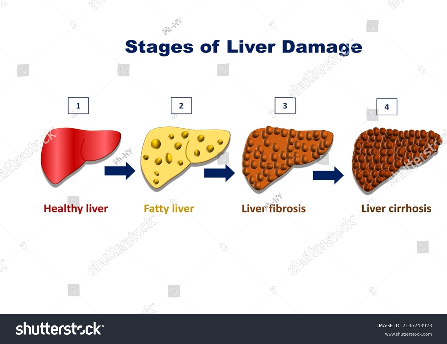 Stages of liver damage, liver injury steps - Royalty Free Stock Vector ...