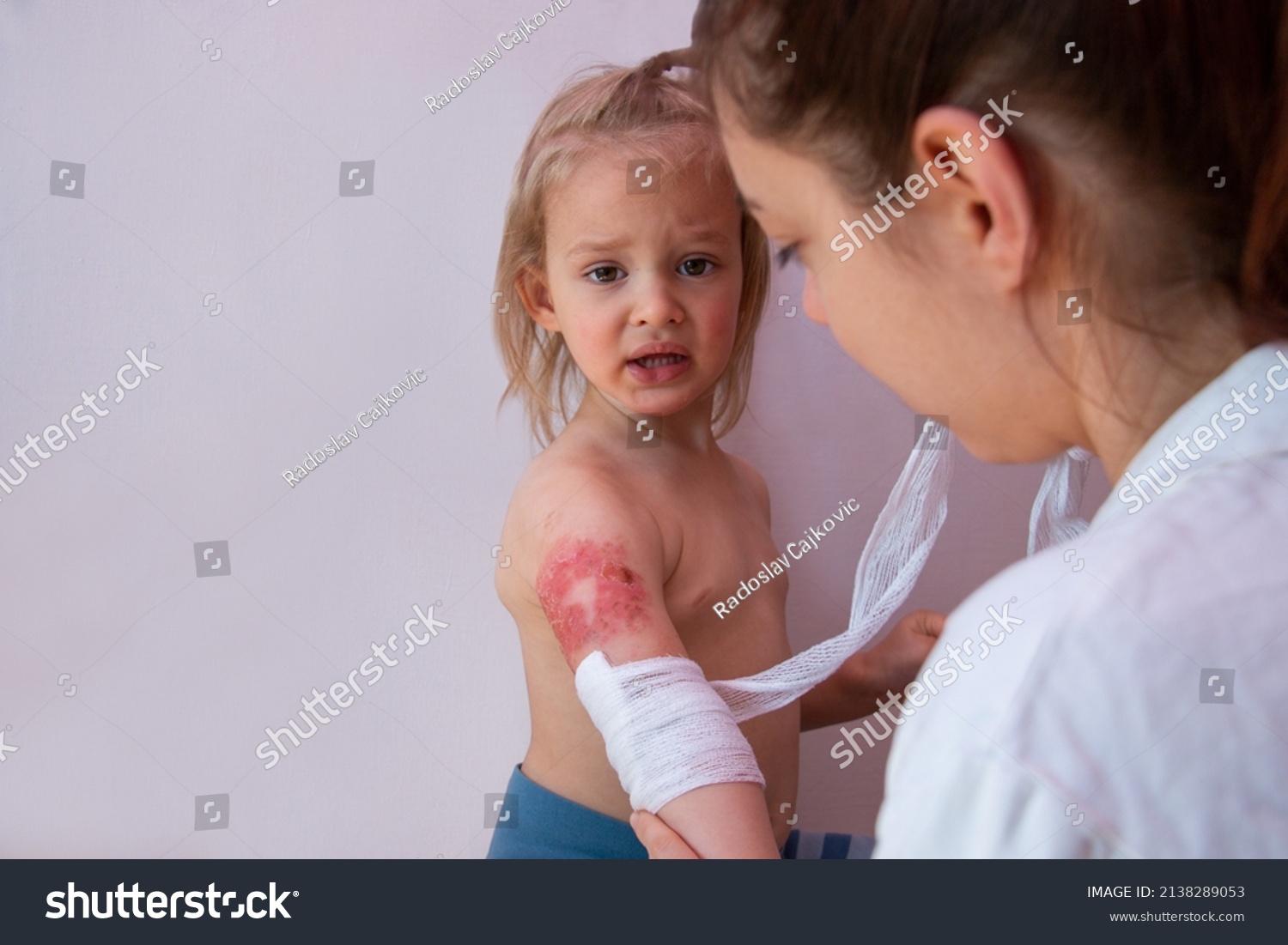 Child burn injury, burns treatment and healing, pediatrician is dressing wound on toddler arm with a sterile non-adhesive bandage #2138289053