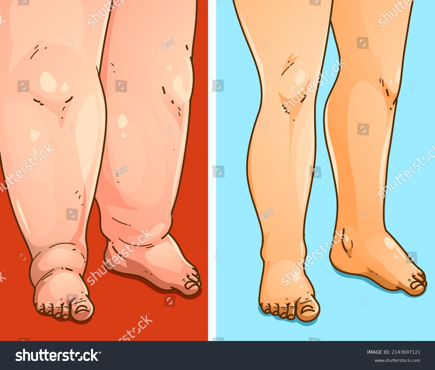 Edema Legs Before After Medical Illustration Royalty Free Stock Vector 2143697121 8605