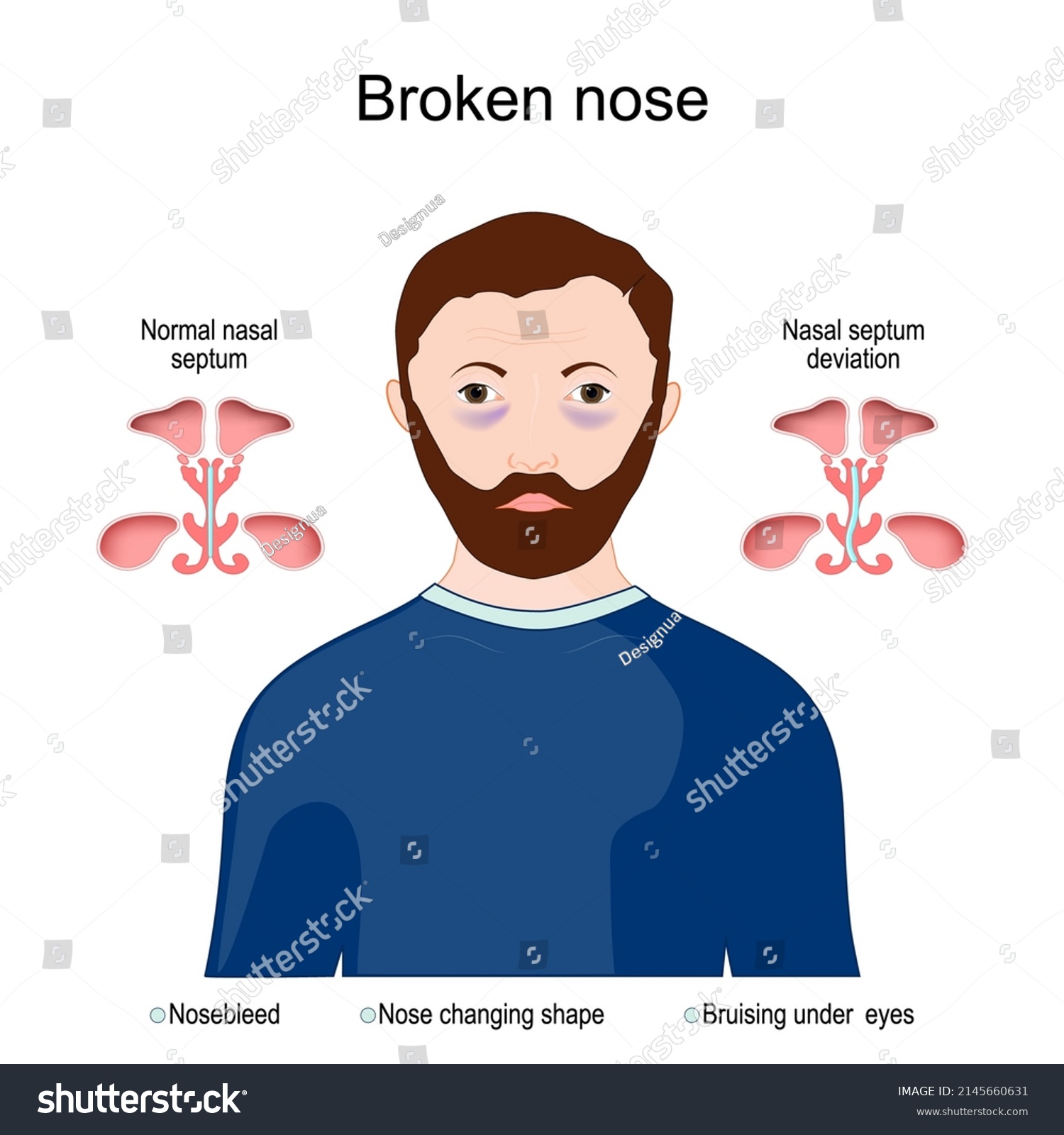 Symptoms of a broken nose nose changing shape, Royalty Free Stock