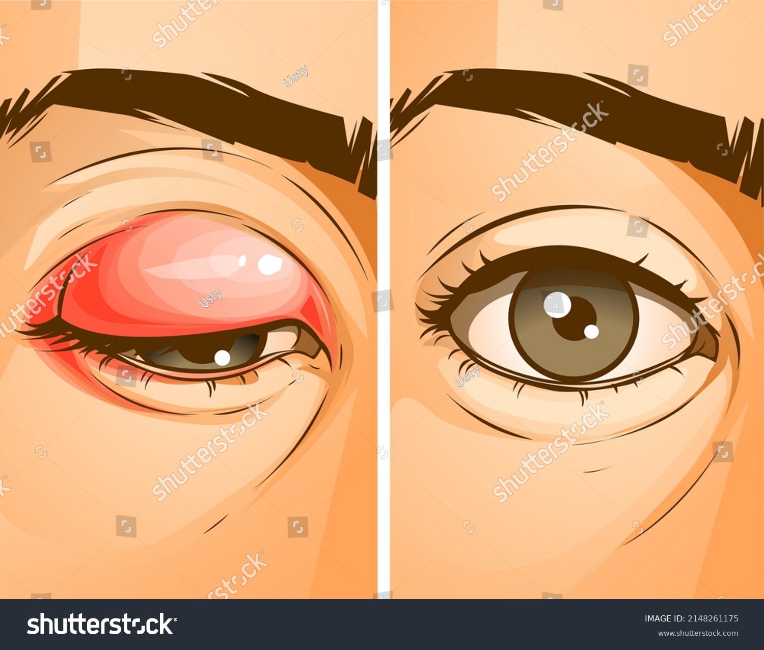 The human eye with the stye. Chalazion. Before, - Royalty Free Stock ...