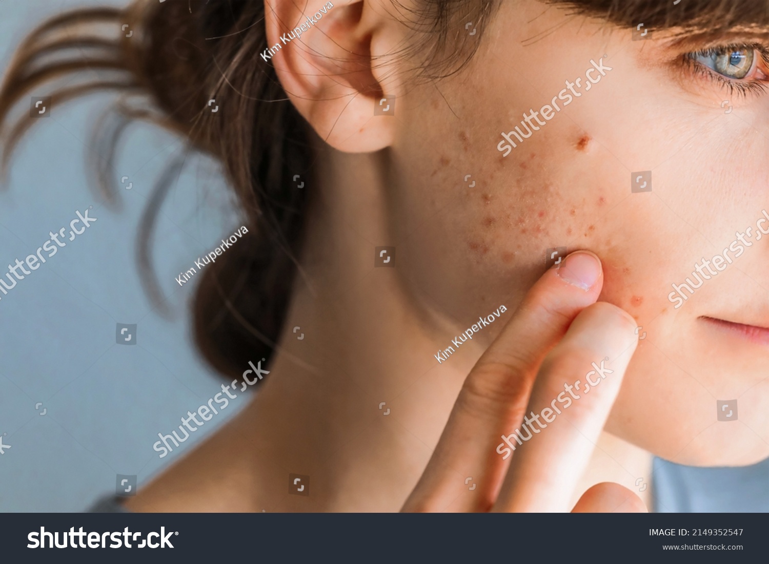 Woman with red cheeks- diathesis or allergy symptoms. Redness and peeling of the skin on the face. Teenage girl with acne problem on beige background, closeup. #2149352547
