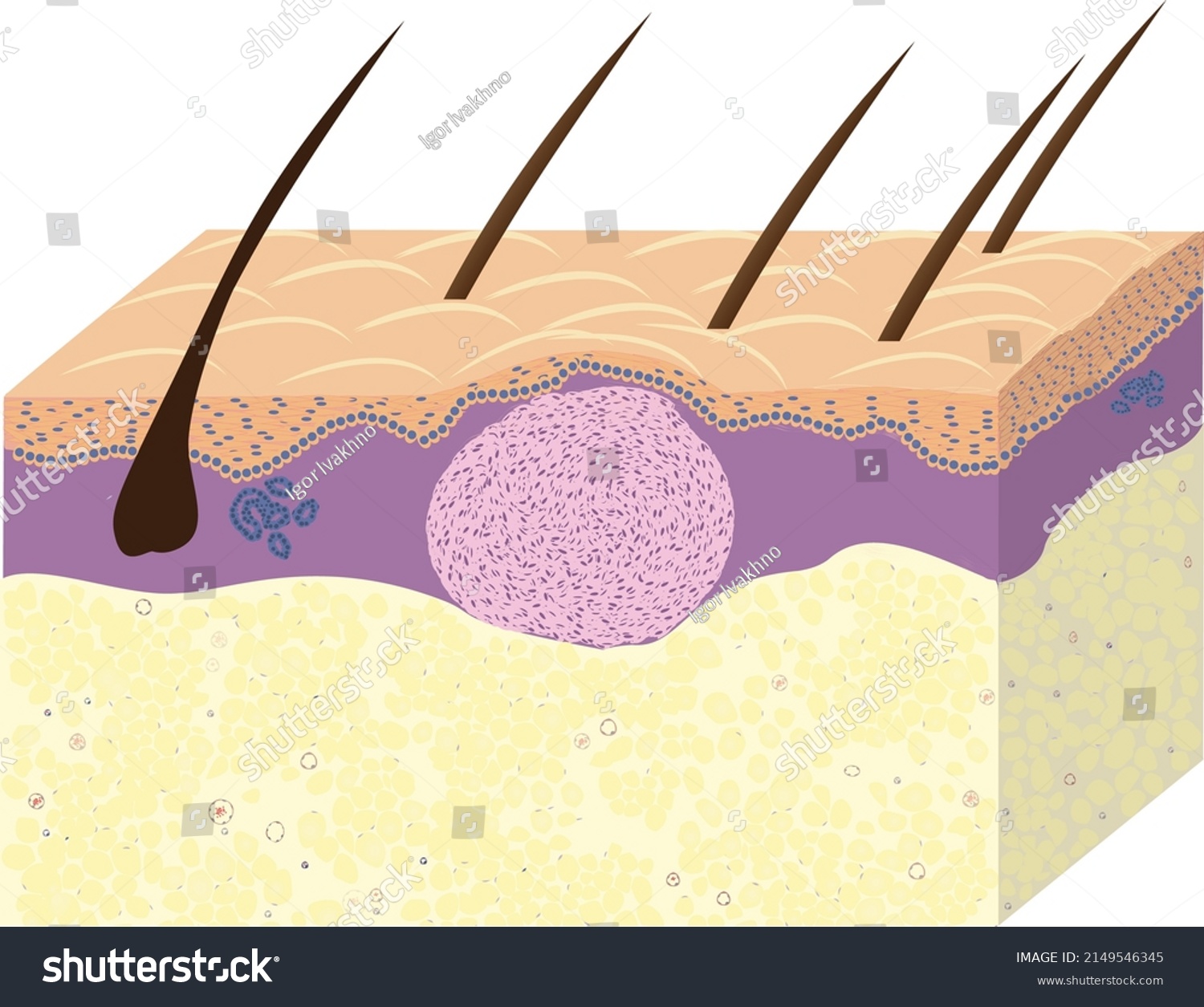 Scheme Of Skin Fibroma Histology Vetcor Royalty Free Stock Vector