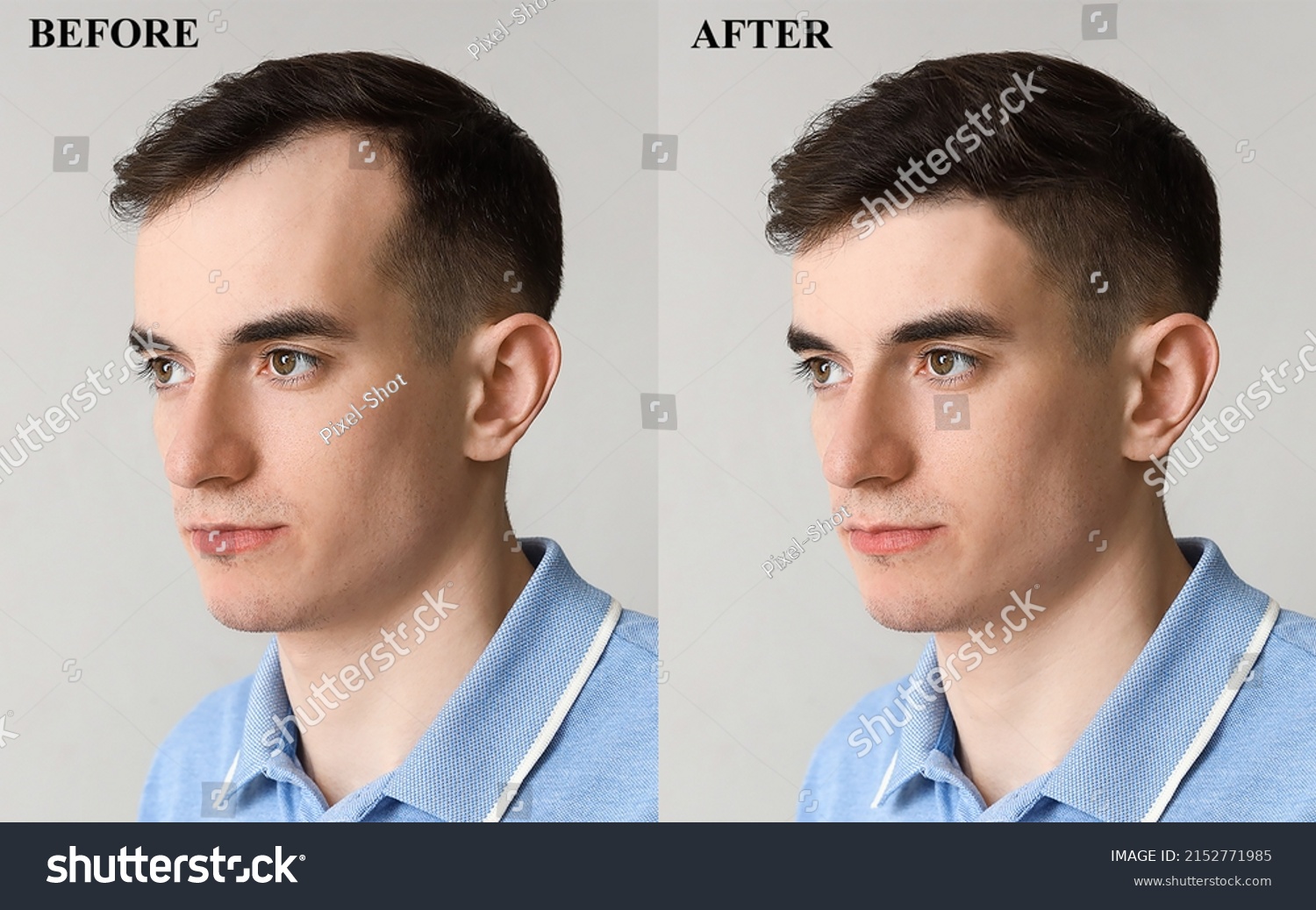 Young man before and after hair loss treatment on light background #2152771985