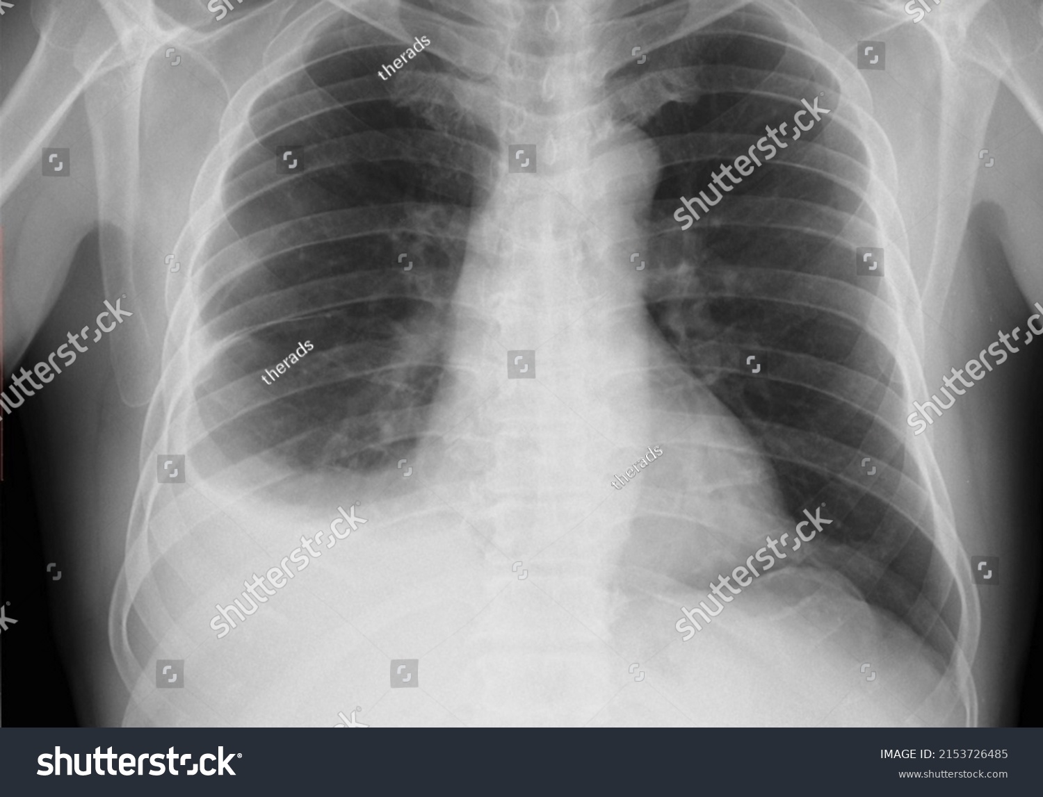 Pleural effusion in chest x-ray, A pleural effusion is a collection of fluid in the pleural space, its shown as  uniformly white lesion on chest x ray, #2153726485