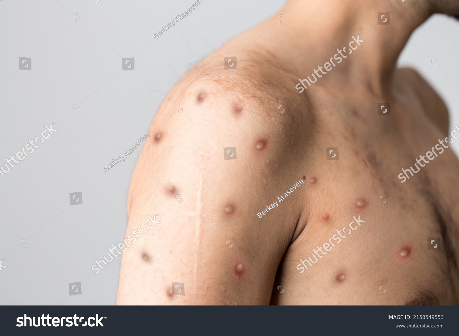 Monkeypox new disease dangerous over the world. #2158549553