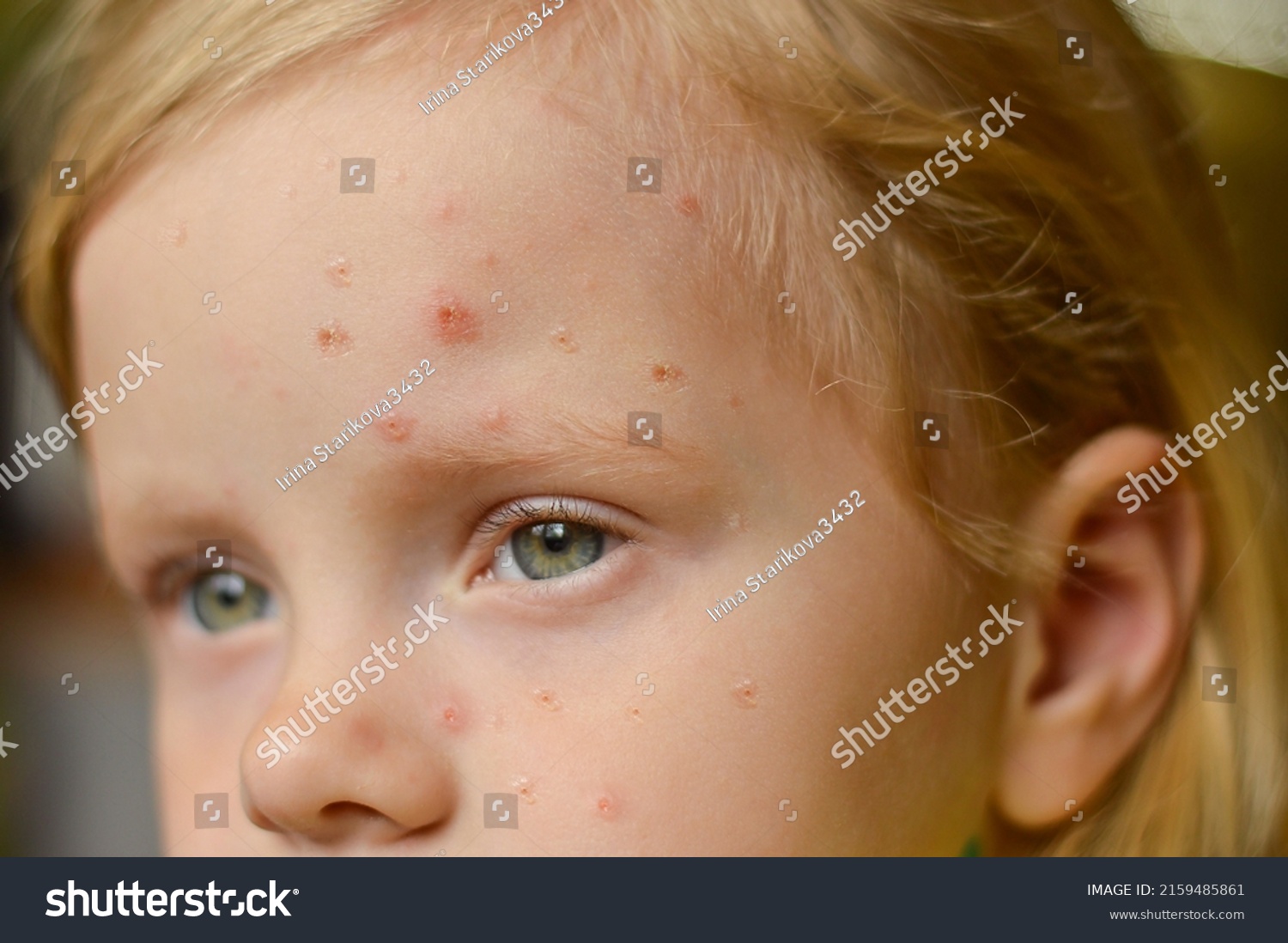 Monkeypox new disease dangerous over the world. Selective focus. Close-up of a Caucasian girl with pimples and ulcers on her face. #2159485861